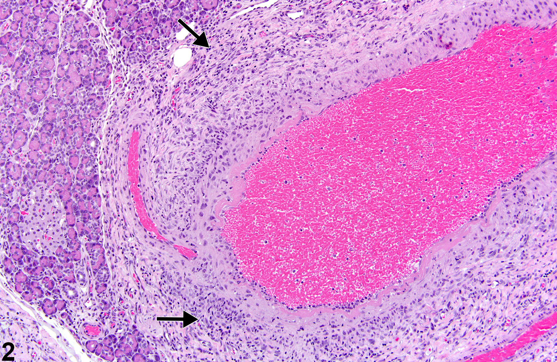 Image of polyarteritis nodosa in the pancreas from a male B6C3F1/N mouse in a chronic study