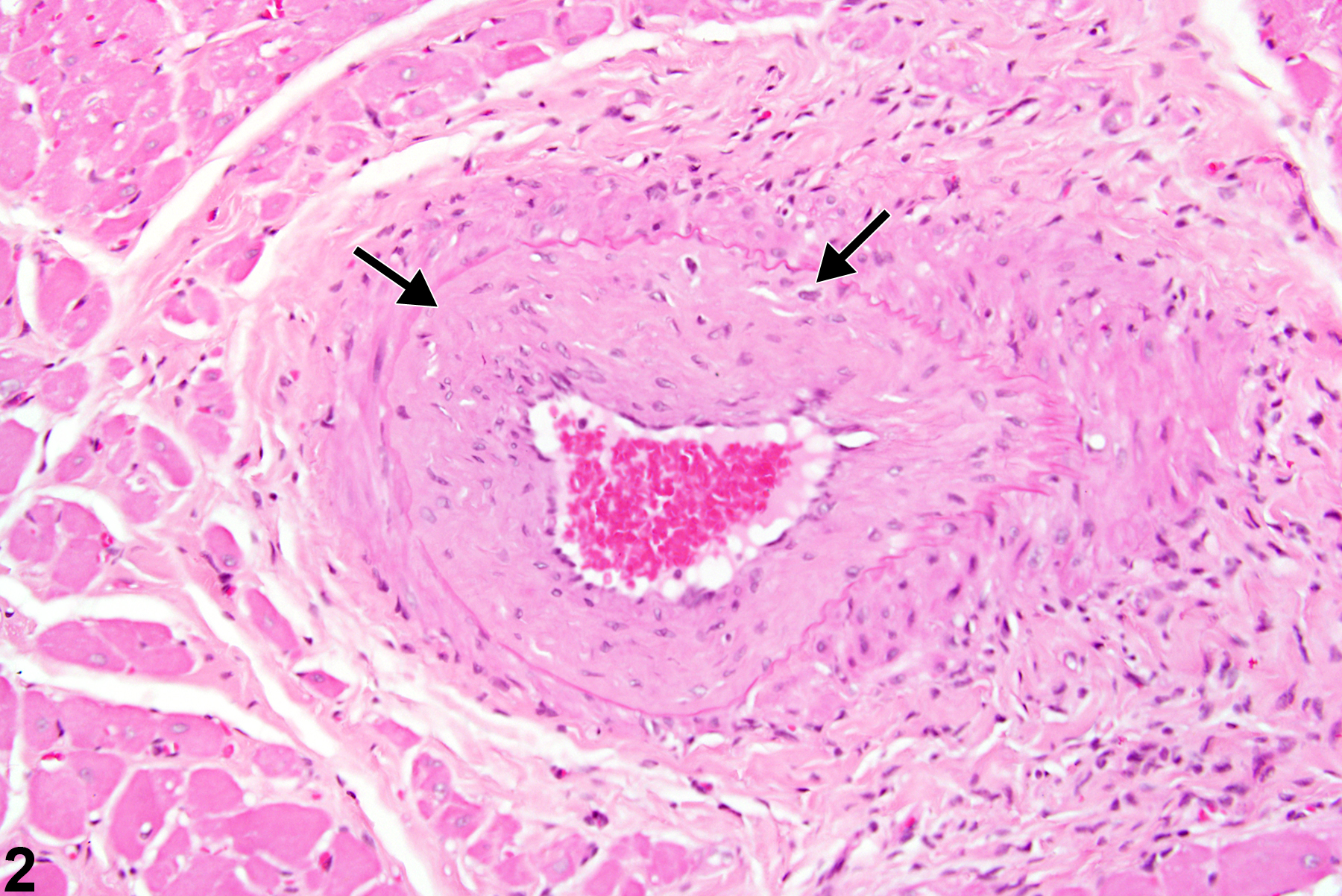Image of proliferation, intimal in the heart, artery from a male F344/N rat in a chronic study