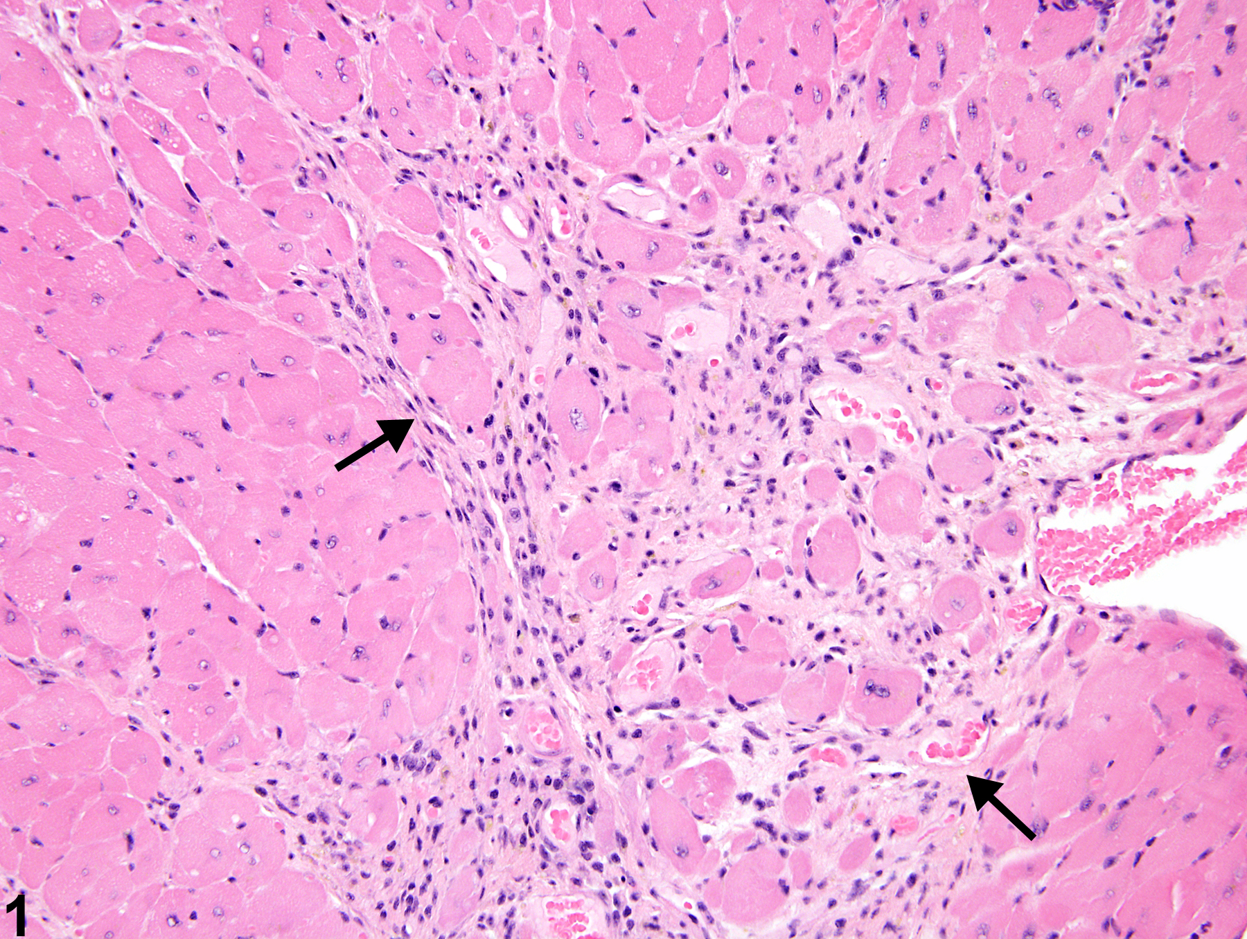 Image of cardiomyopathy in the heart from a male B6C3F1/N mouse in a chronic study
