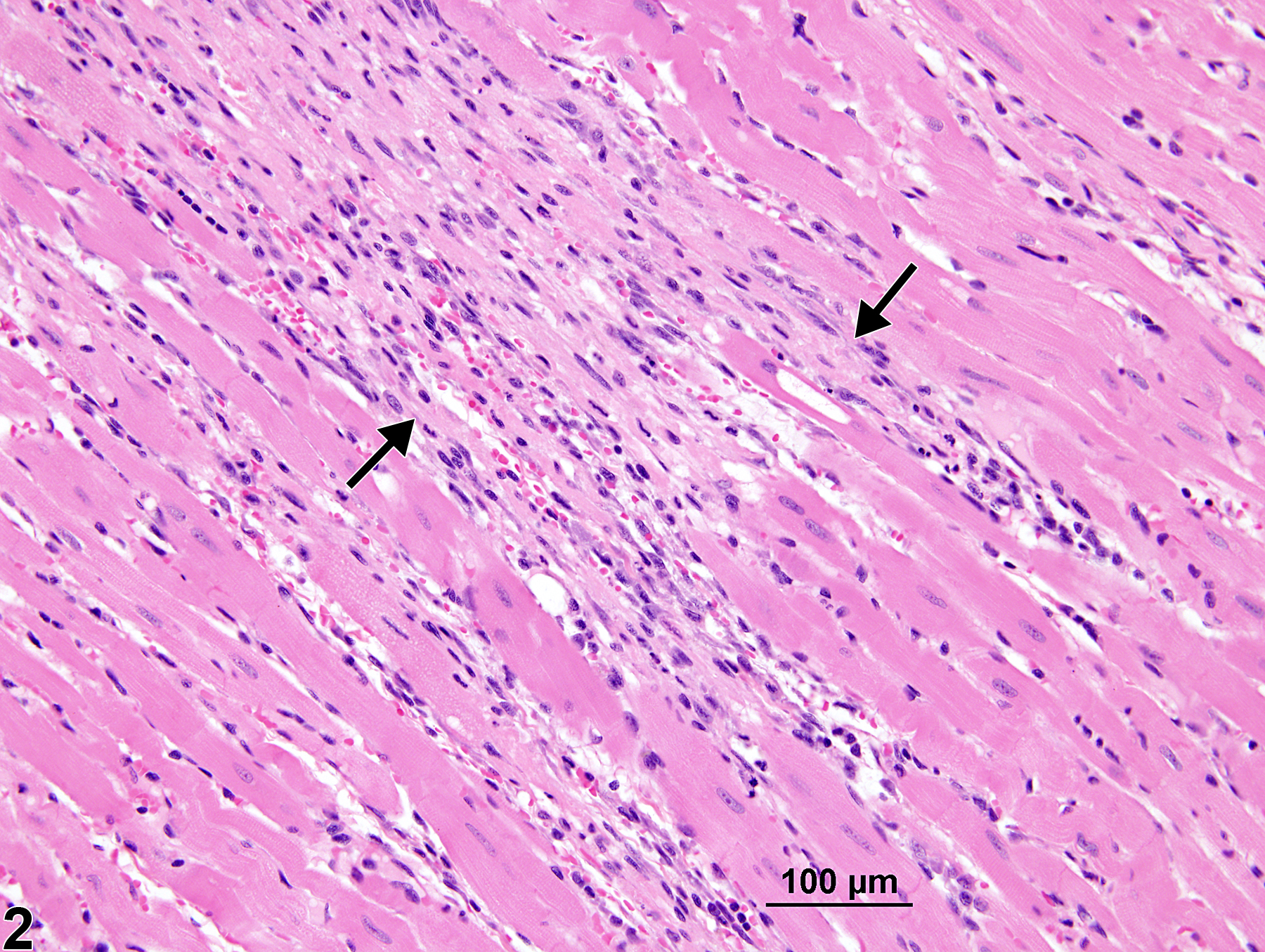 Image of cardiomyopathy in the heart from a female Harlan Sprague-Dawley rat in a chronic study