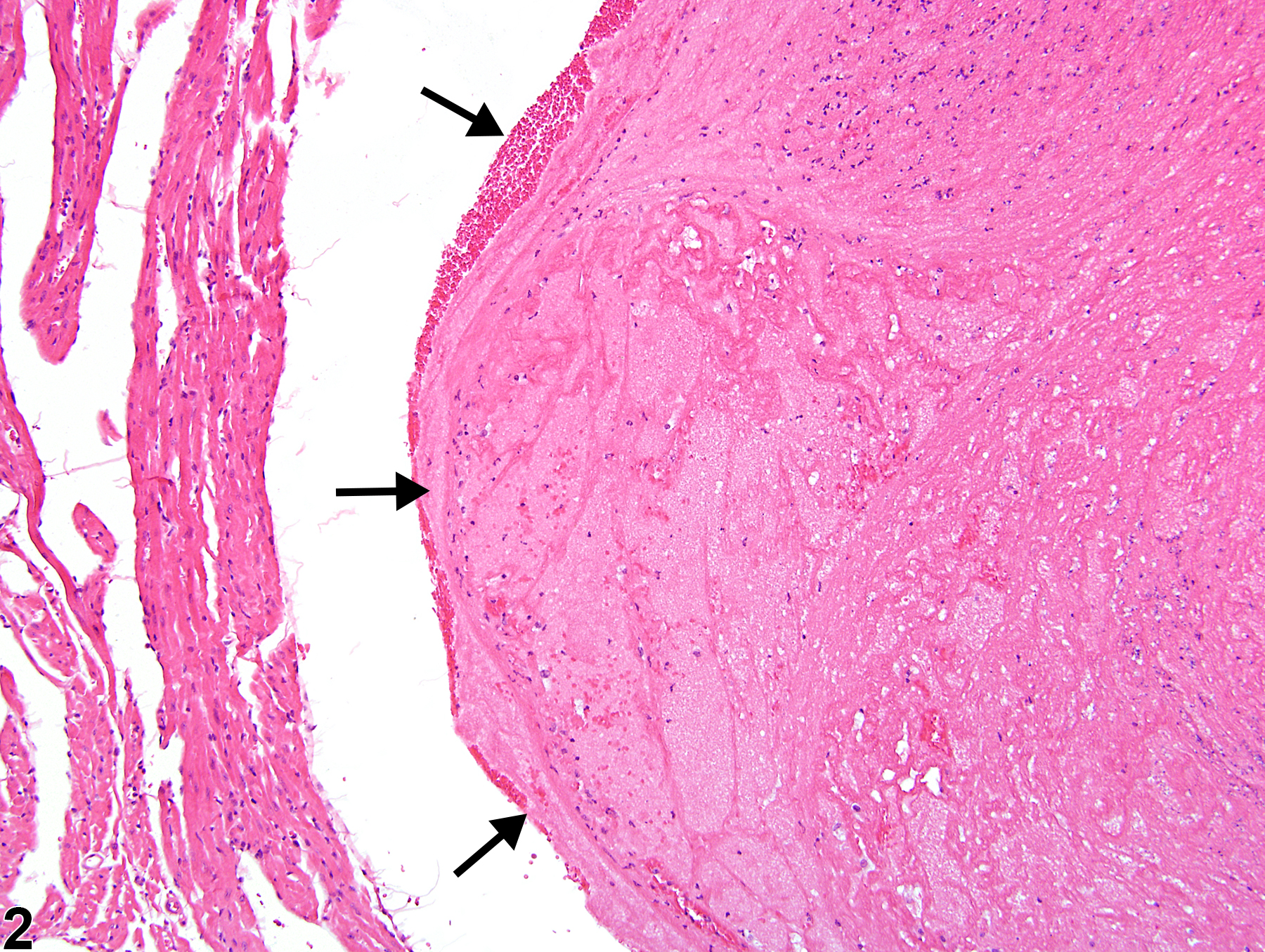 Image of thrombus in the heart, atrium from a male Swiss Webster mouse in a chronic study