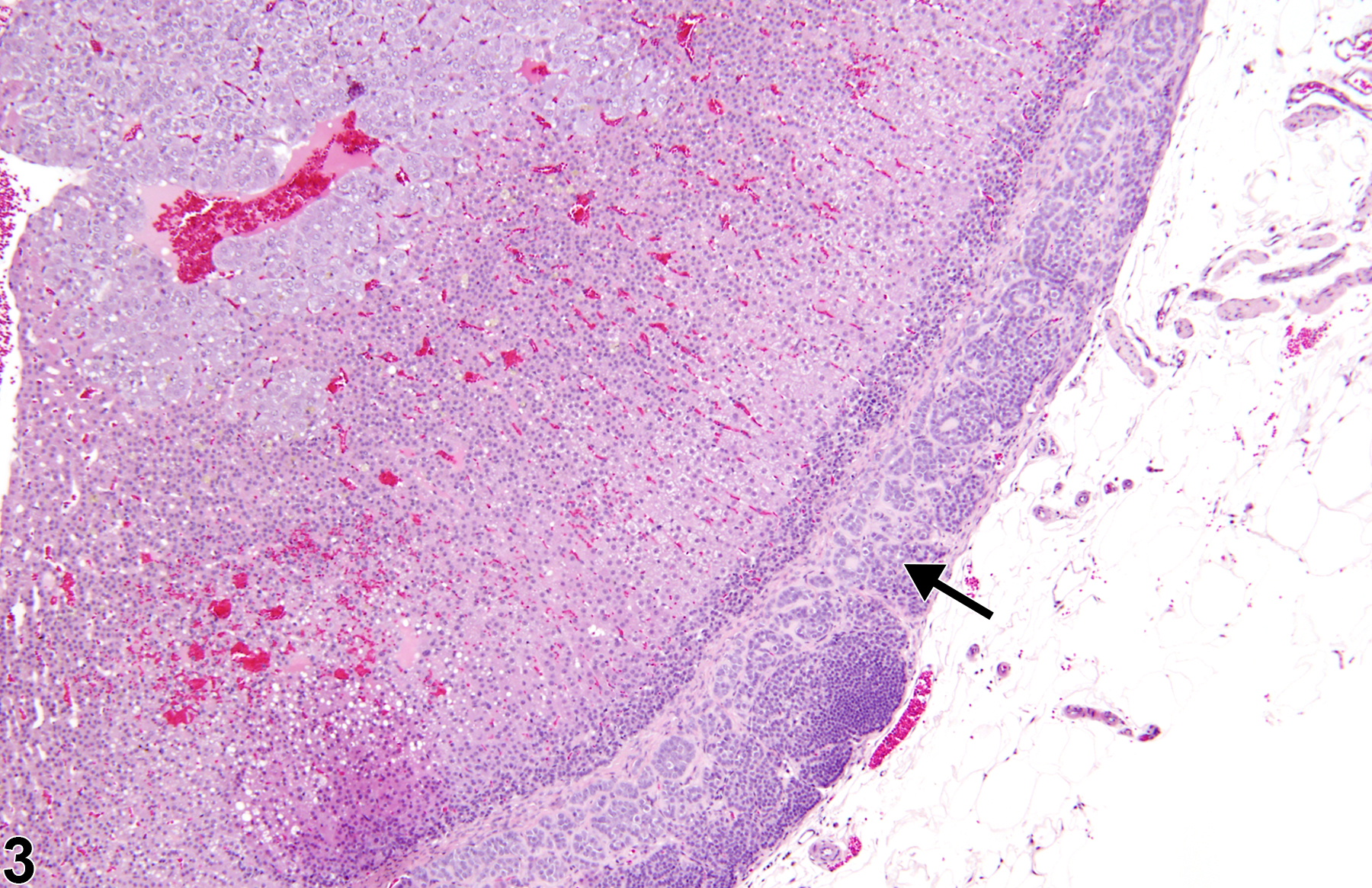 Image of accessory adrenocortical nodule in the adrenal gland from a male F344/N rat in a chronic study