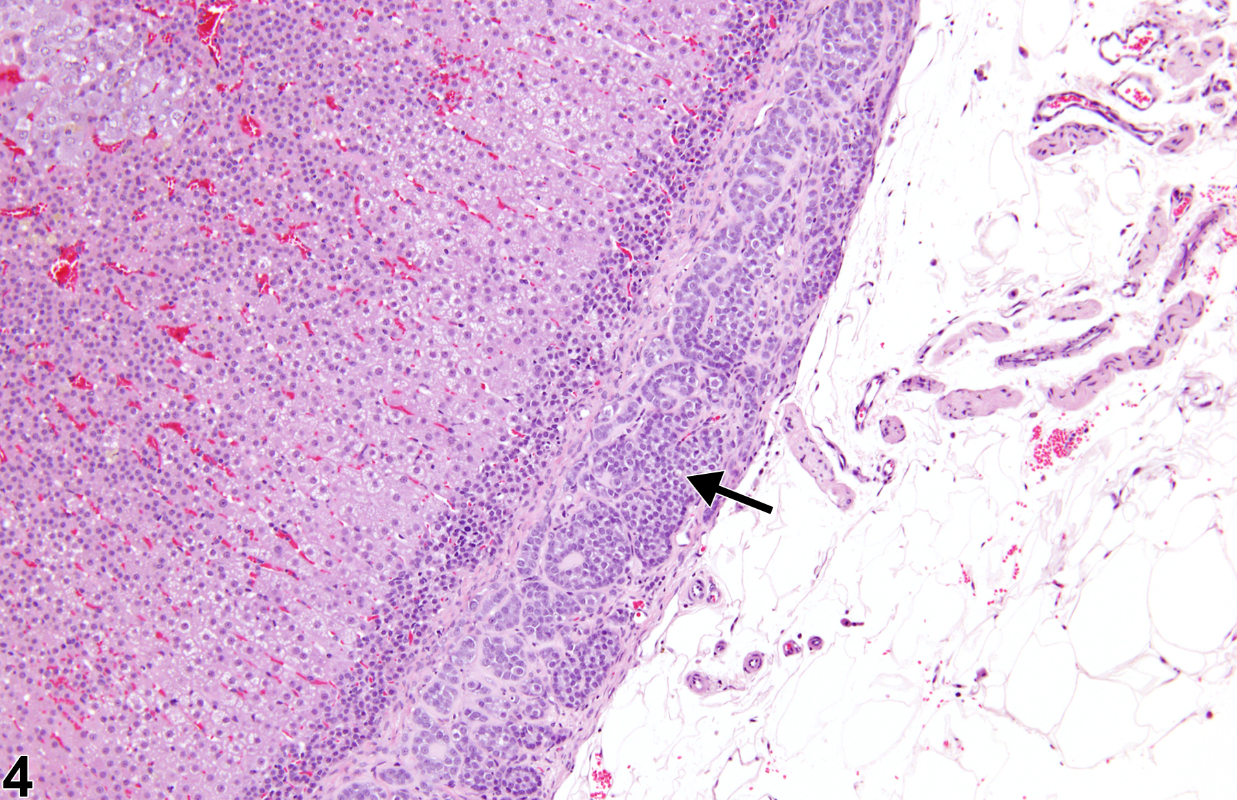 Image of accessory adrenocortical nodule in the adrenal gland from a male F344/N rat in a chronic study