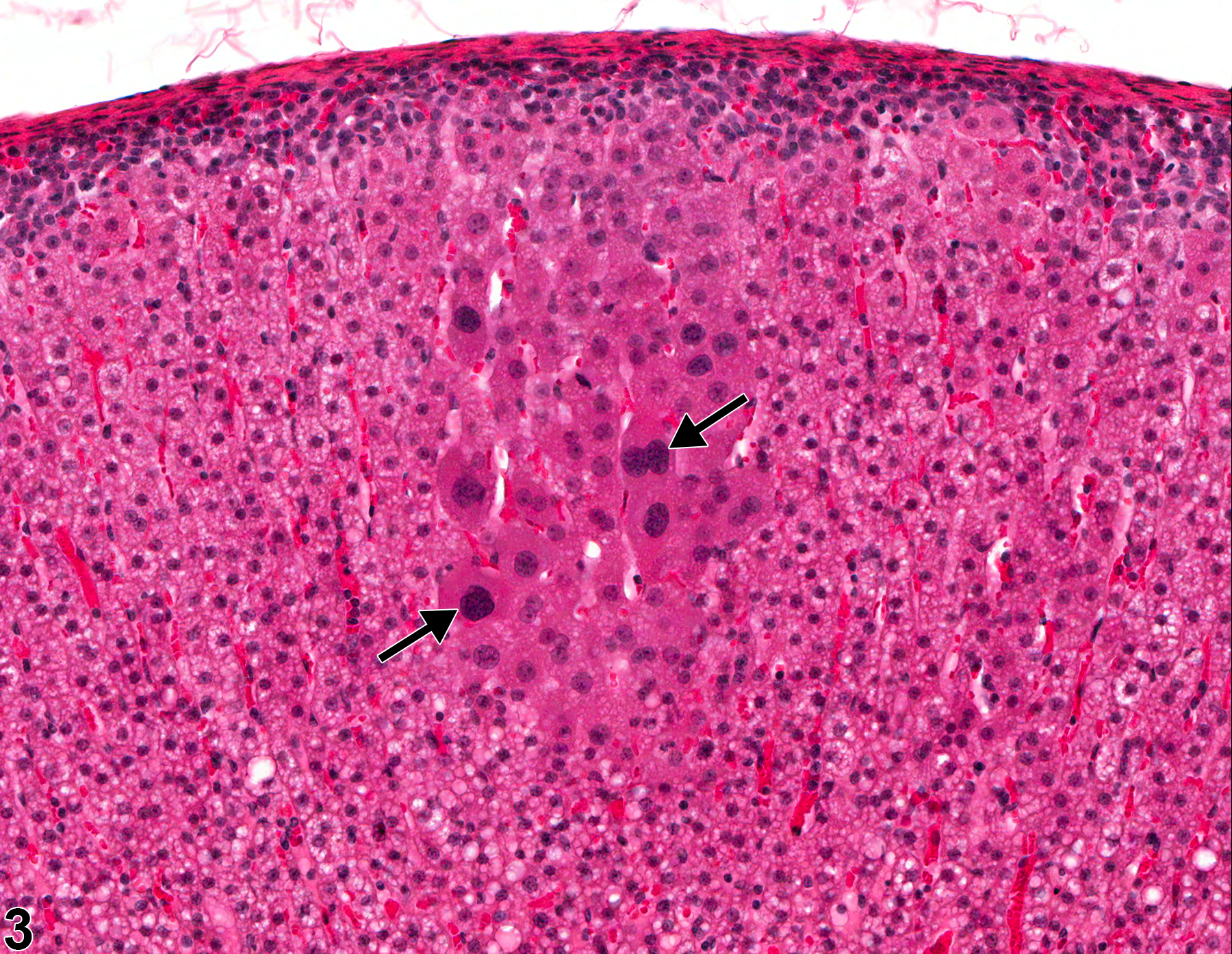 Image of cellular atypia in the adrenal gland cortex from a male F344/N rat in a chronic study