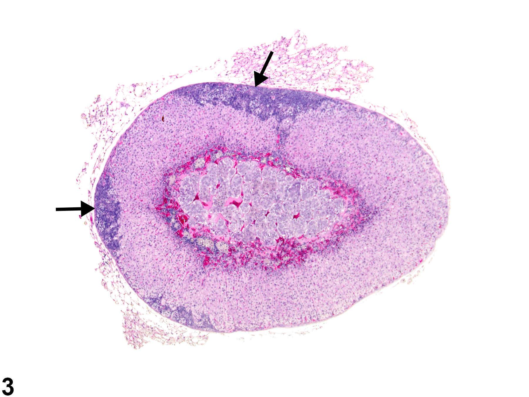 Image of hyperplasia, subcapsular in the adrenal gland cortex from a female B6C3F1/N mouse in a chronic study