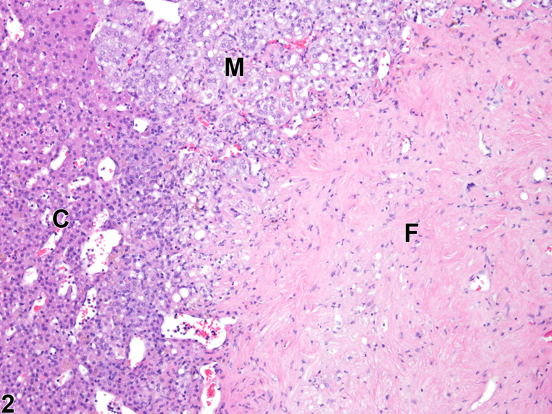 Image of fibrosis in the adrenal gland from a female F344/N rat in a chronic study