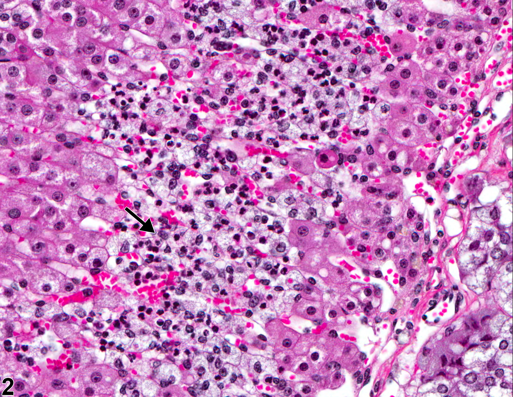 Image of inflammation in the adrenal gland cortex from a female B6C3F1/N mouse in a chronic study