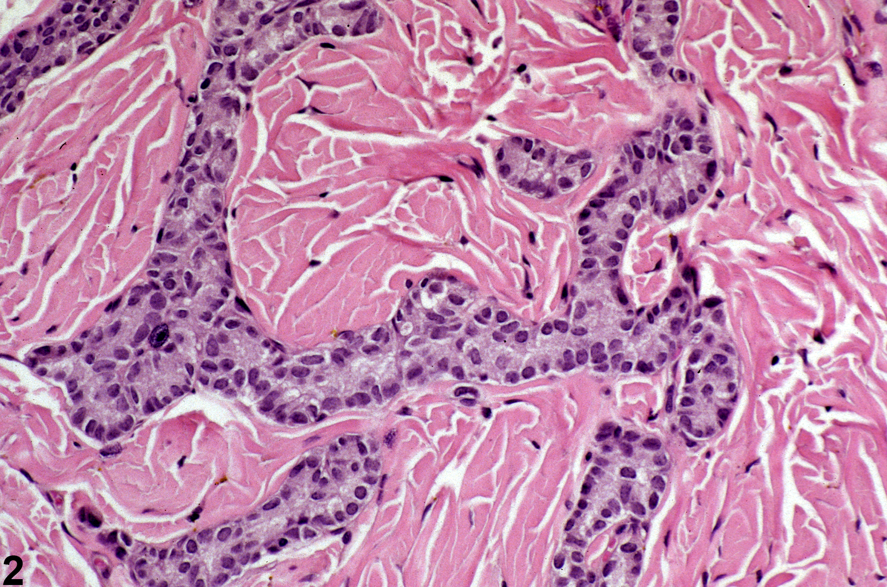 Image of fibrosis in the parathyroid gland from a female F344/N rat in a chronic study