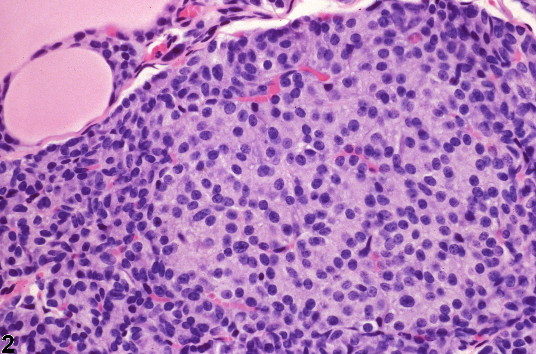 Image of hyperplasia, focal in the parathyroid gland from a male F344/N rat in a chronic study