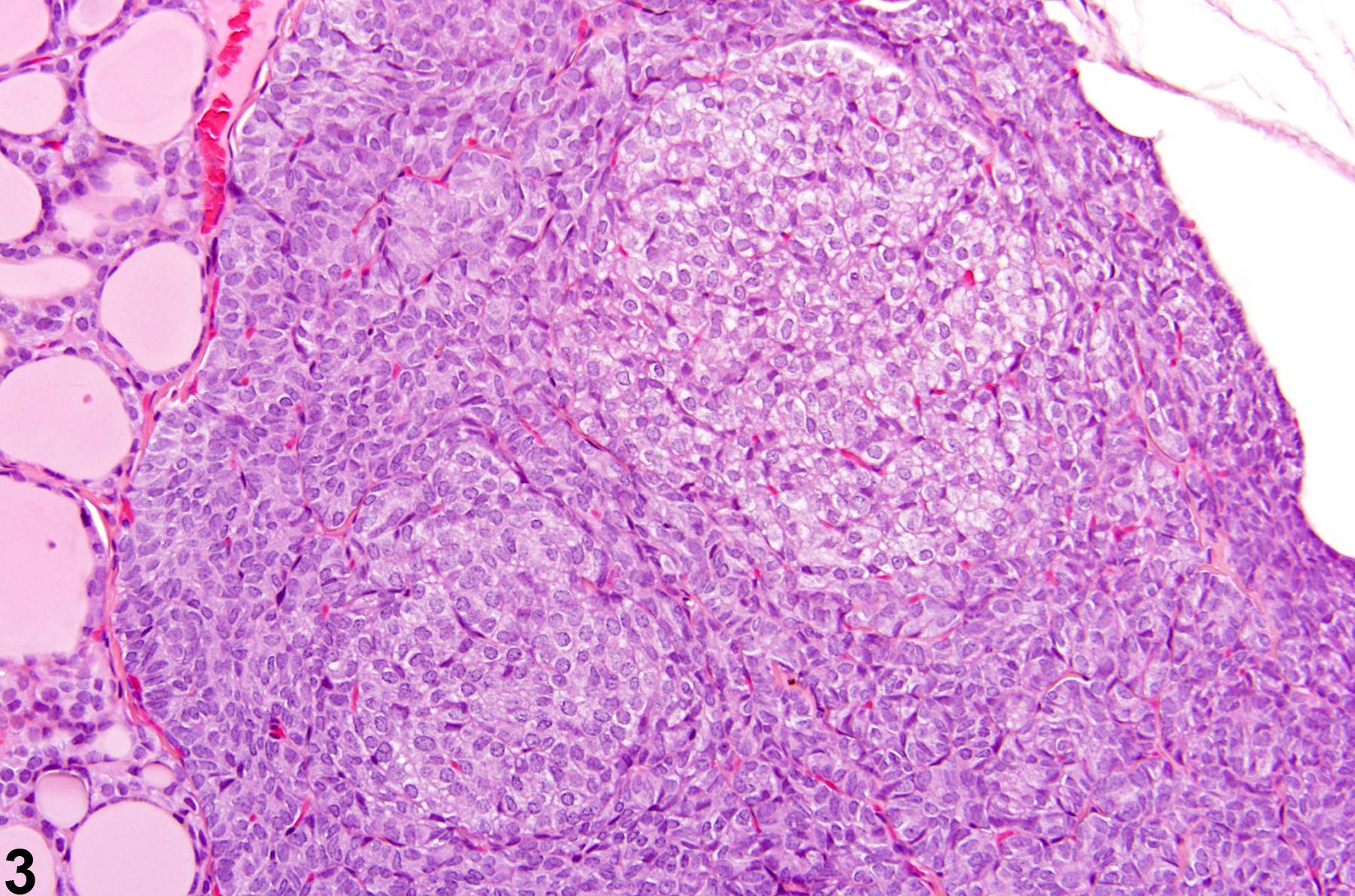 Image of hyperplasia, focal in the parathyroid gland from a male Wistar Han rat in a chronic study