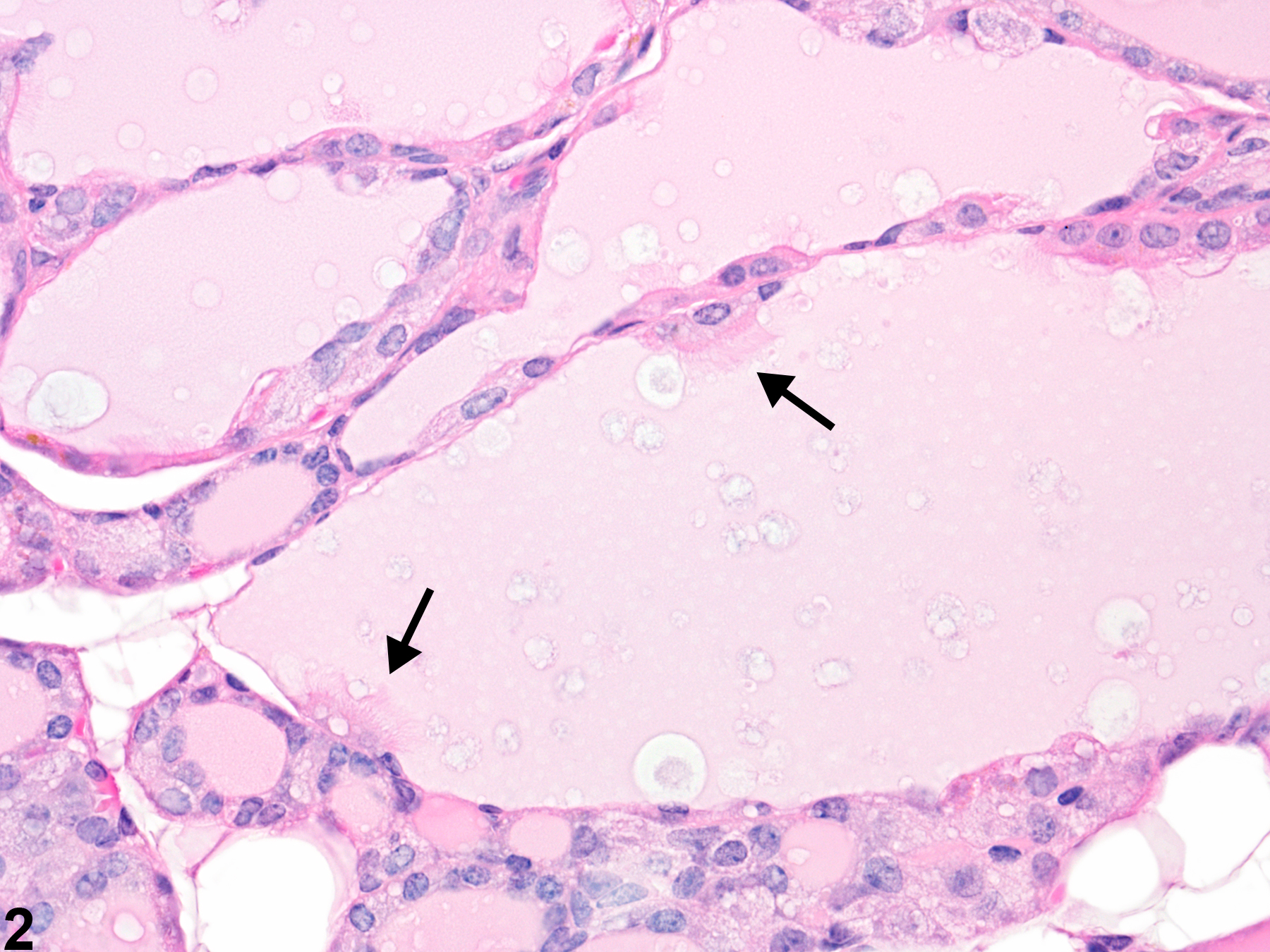 Image of follicle degeneration in the thyroid gland from a female B6C3F1 mouse in a chronic study