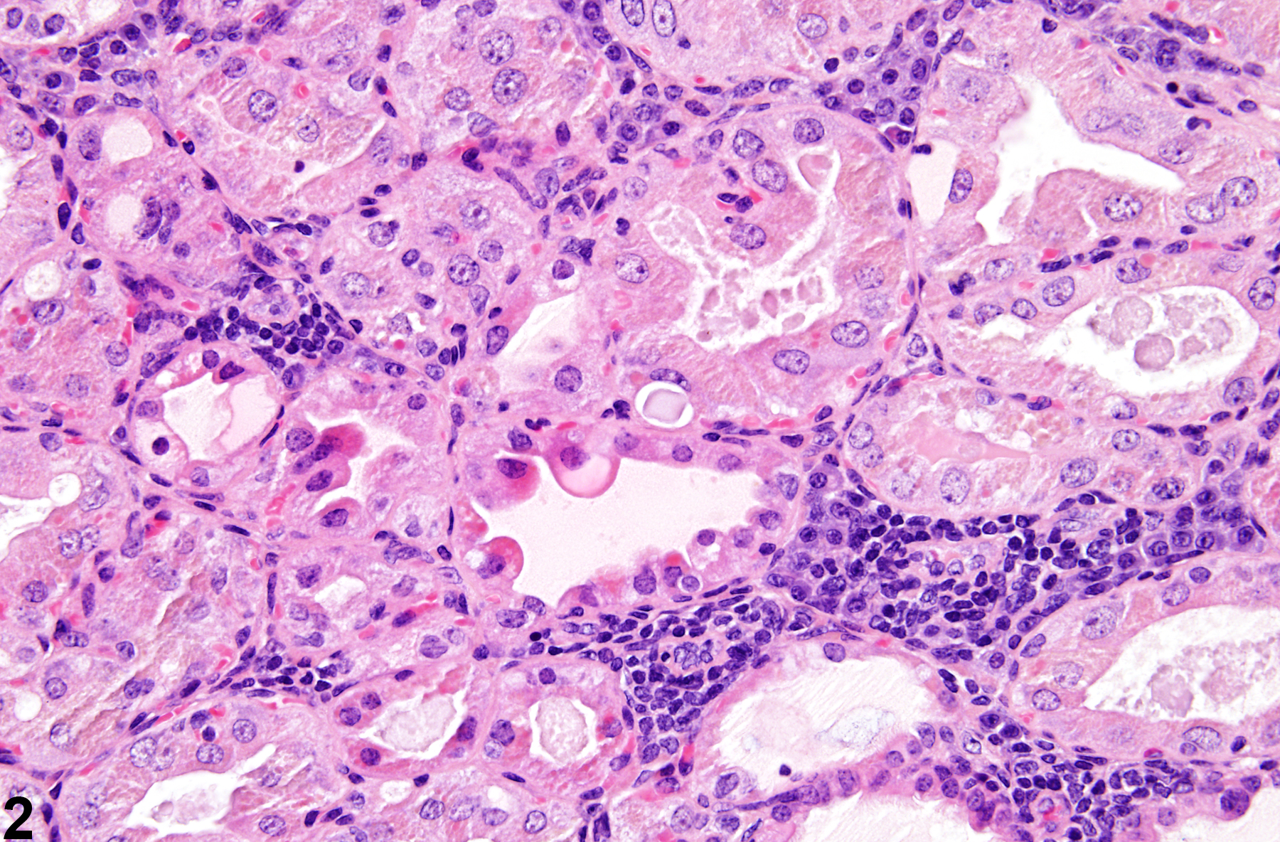 Image of inflammation in the thyroid gland from a female Tg.AC (FVB/N) mouse in a chronic study