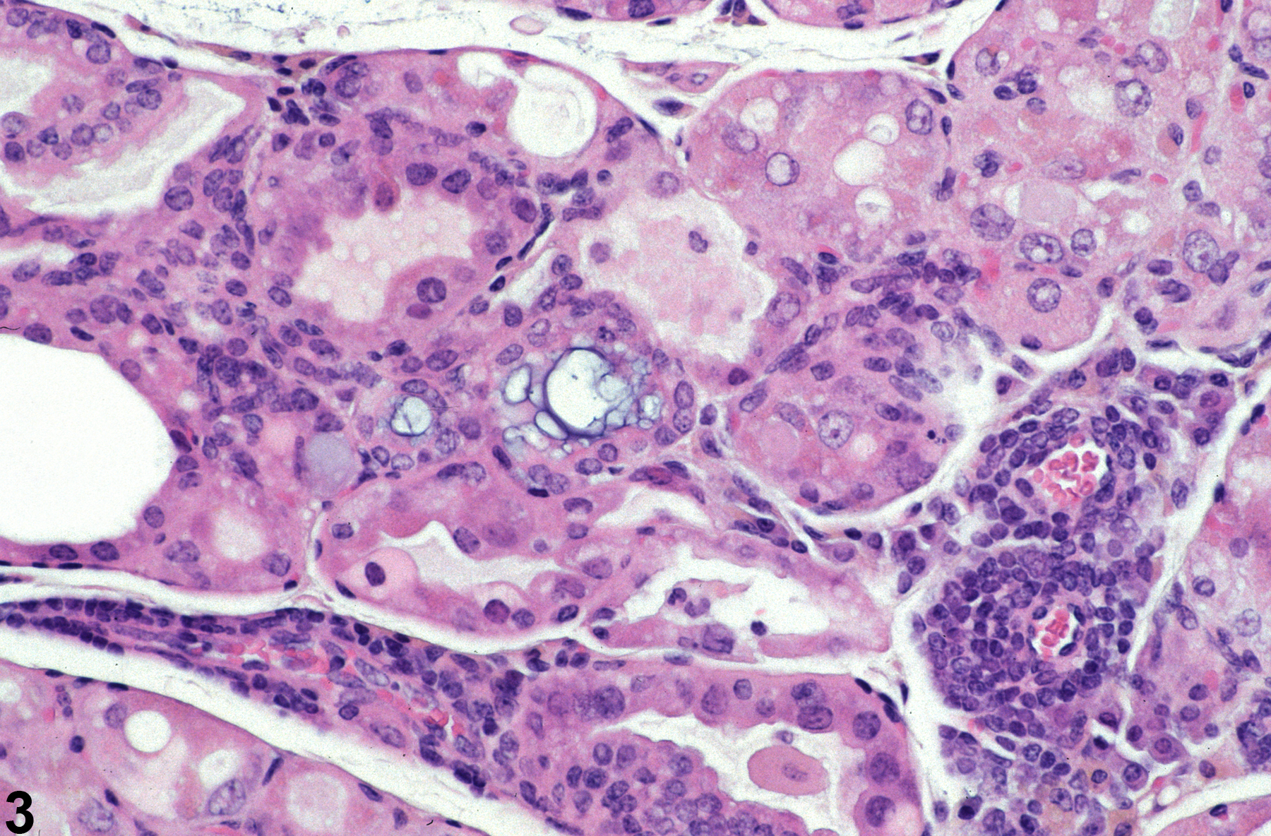 Image of inflammation in the thyroid gland from a female Tg.AC (FVB/N) mouse in a chronic study