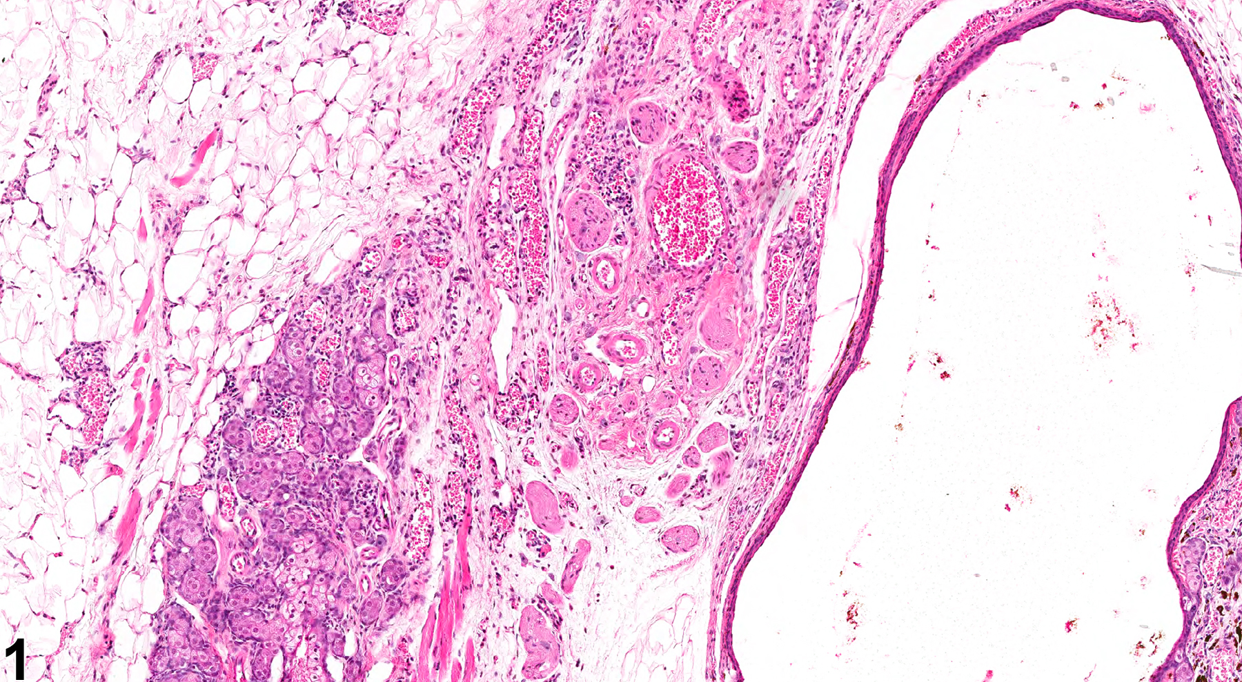 Image of angiectasis in the clitoral gland from a female B6C3F1 mouse in a chronic study