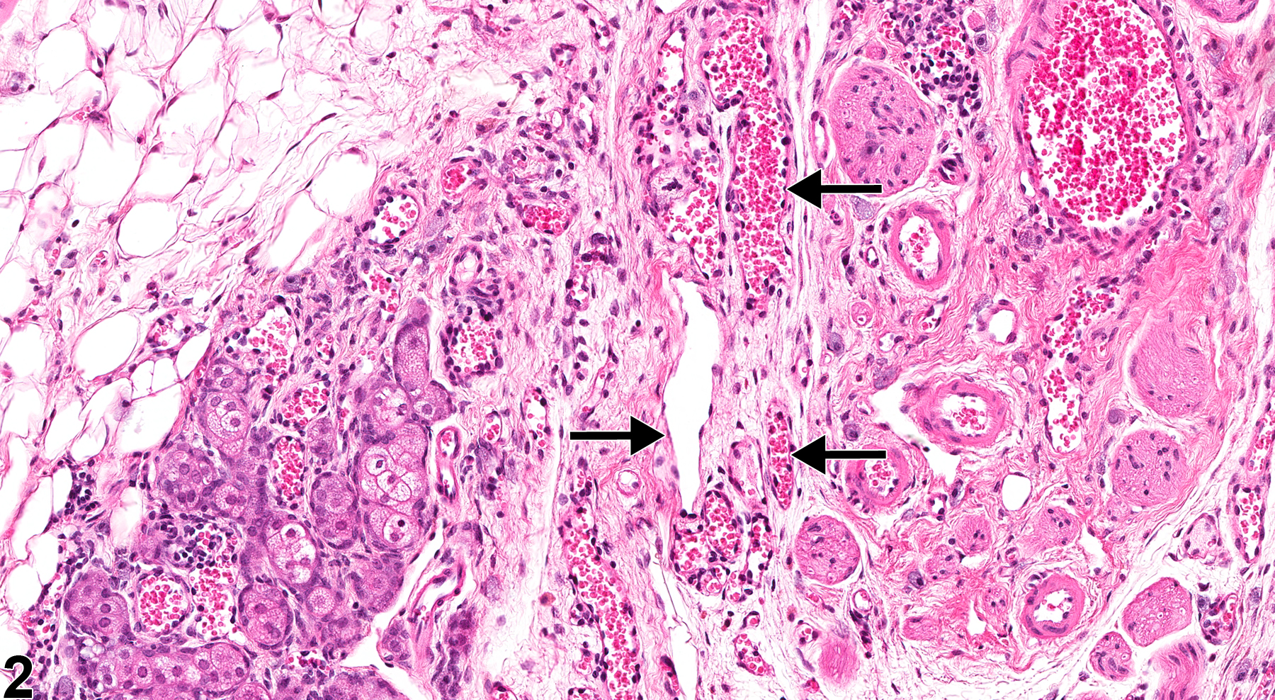 Image of angiectasis in the clitoral gland from a female B6C3F1 mouse in a chronic study