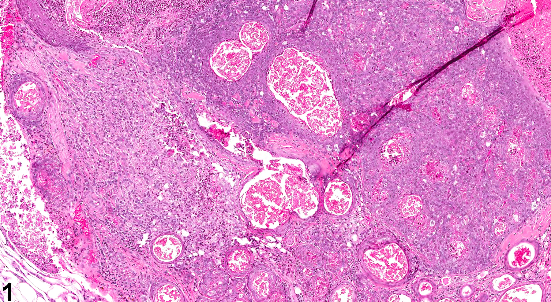 Image of inflammation, chronic active in the clitoral gland from a female F344/N rat in a chronic study