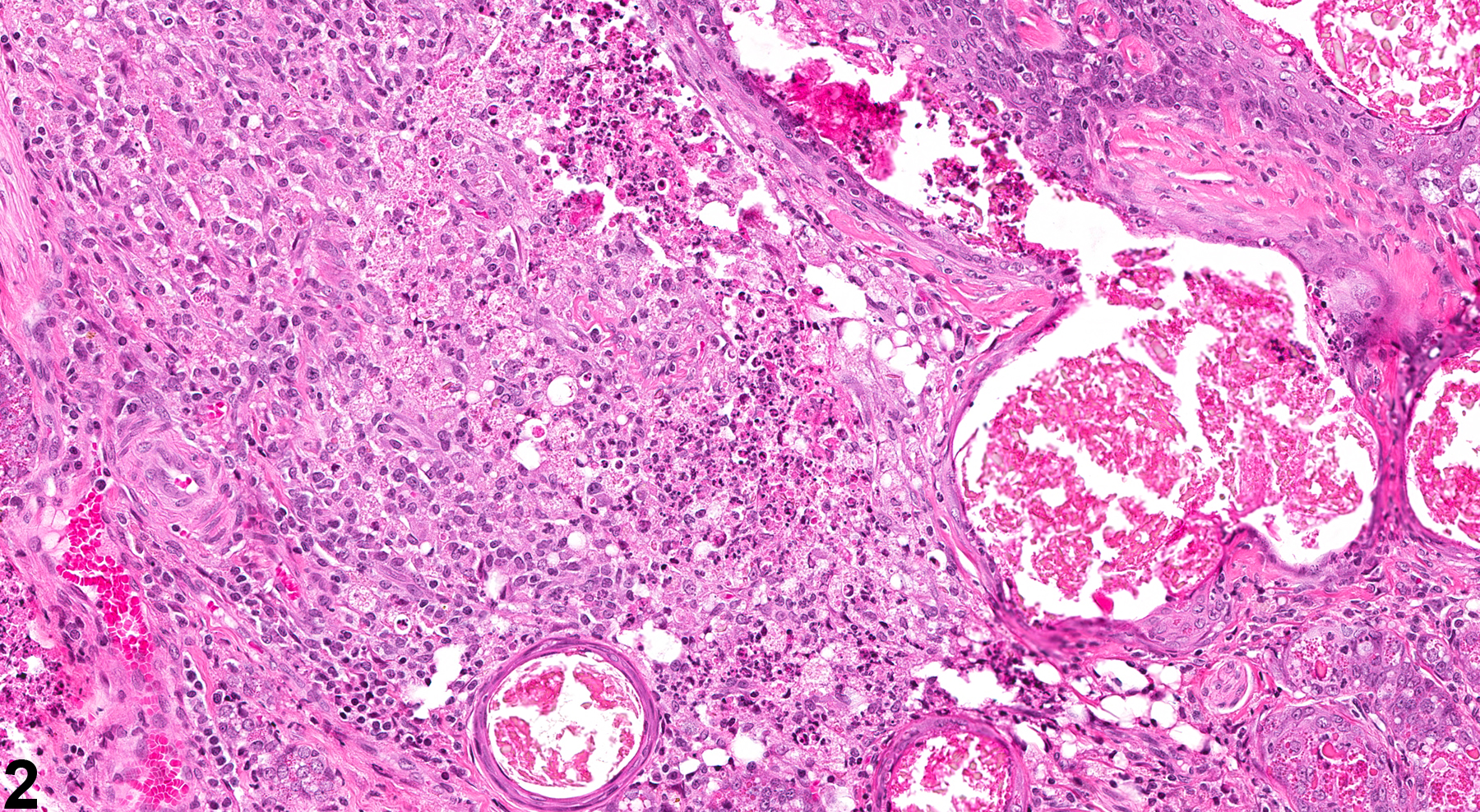 Image of inflammation, chronic active in the clitoral gland from a female F344/N rat in a chronic study