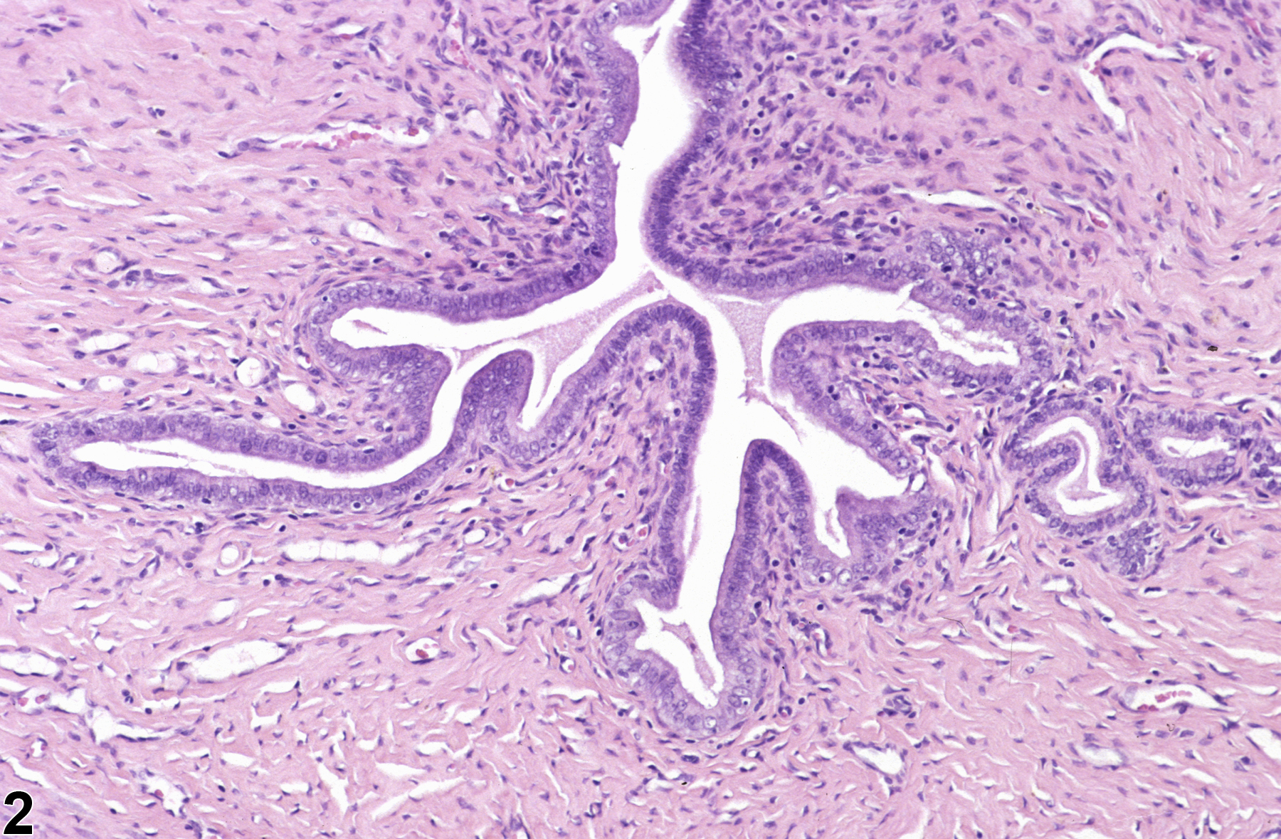 Image of hyperplasia, stromal in the uterus from a female F344/N rat in a chronic study