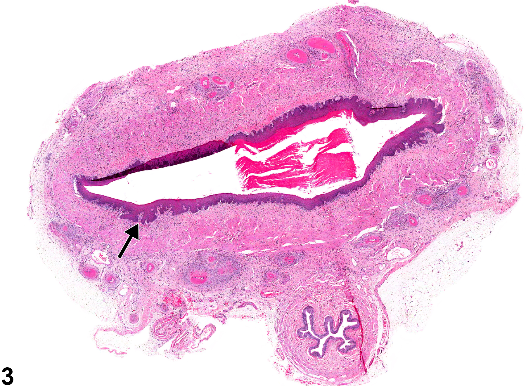 Image of hyperplasia in the vagina from a female Sprague-Dawley rat in a chronic study