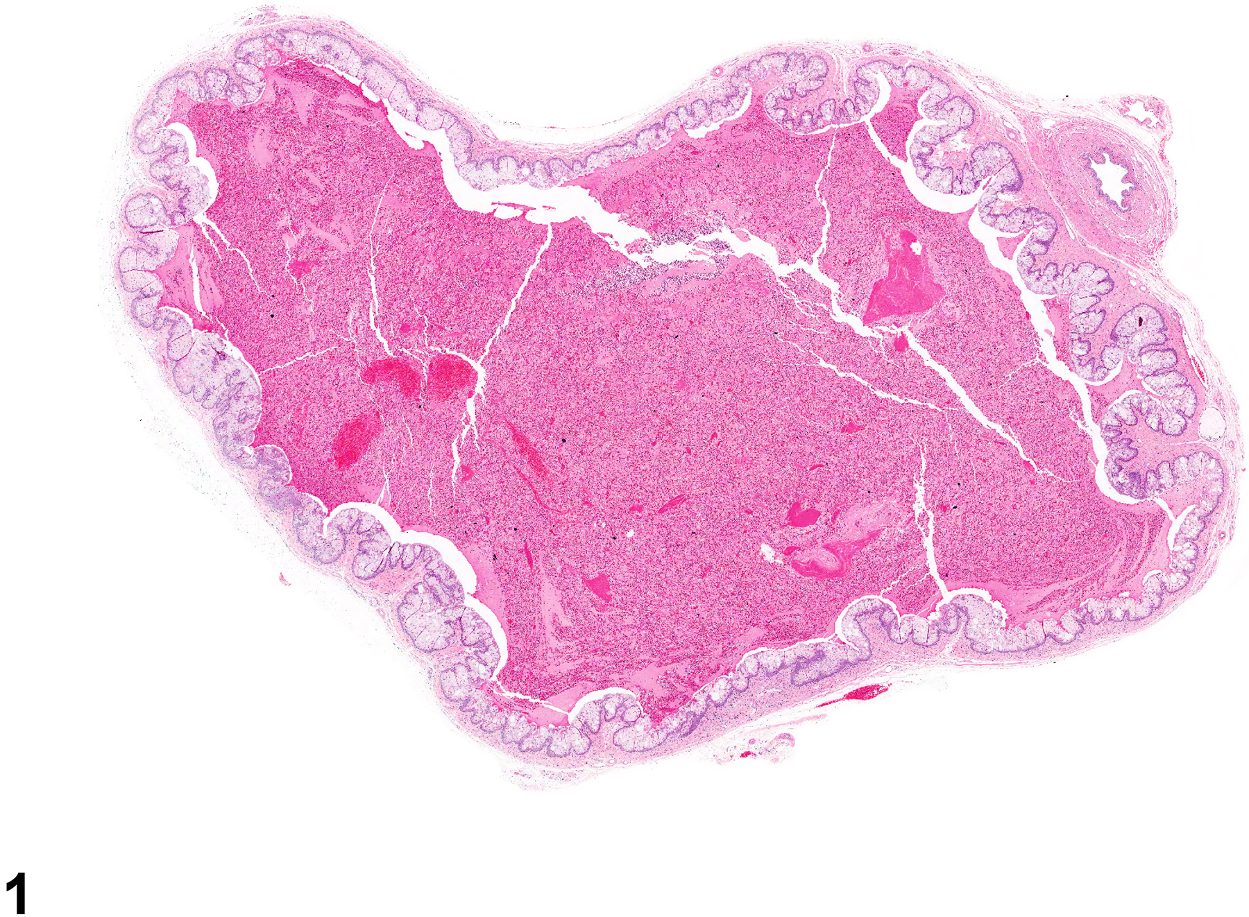 Image of inflammation, acute in the vagina from a female F344/N rat in a chronic study