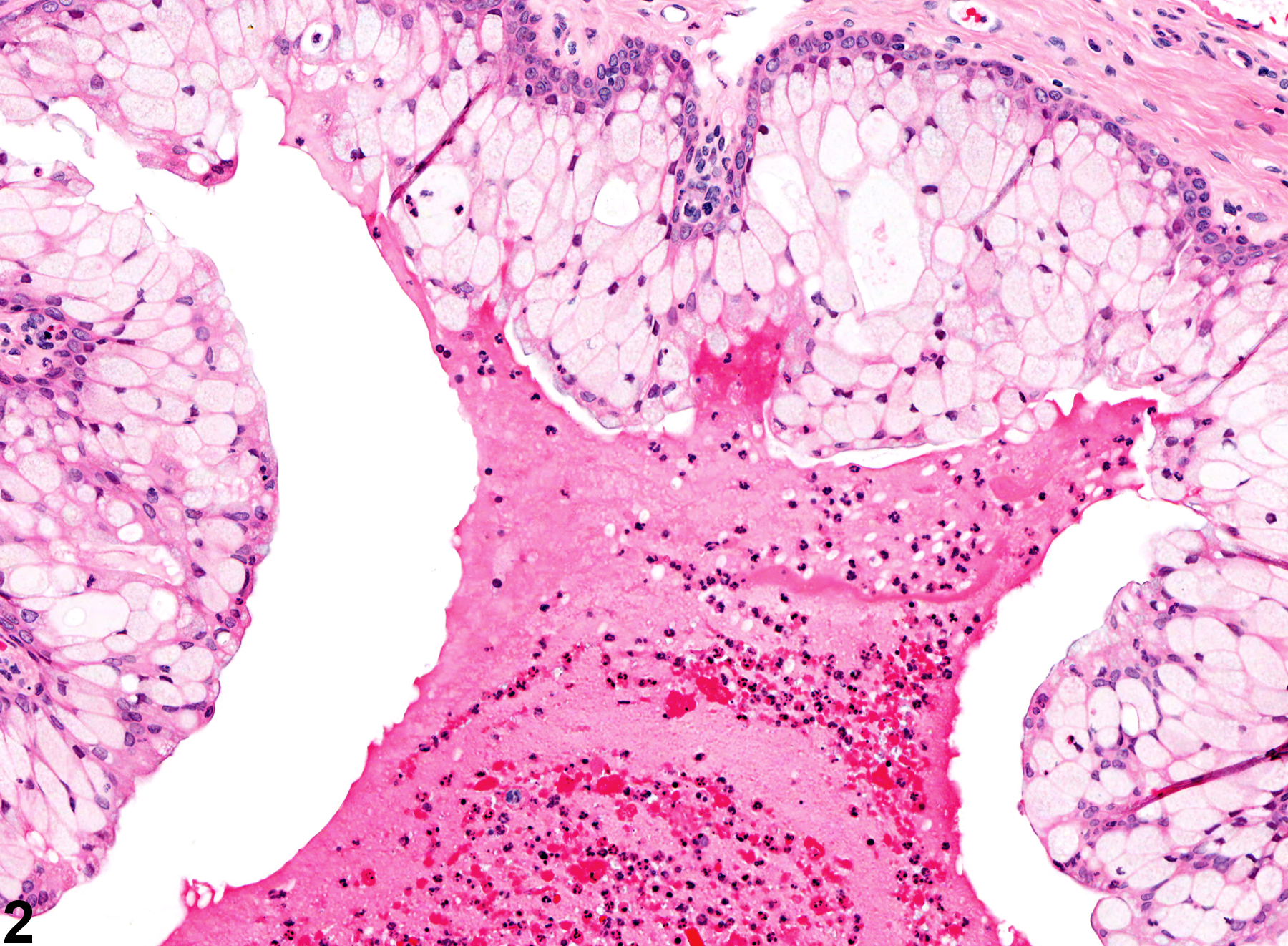 Image of inflammation, acute in the vagina from a female F344/N rat in a chronic study