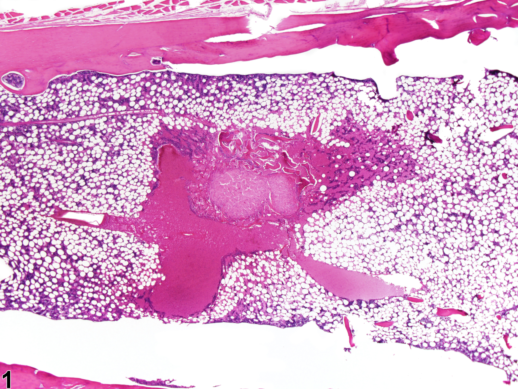 Image of fibrosis in the bone marrow from a male F344/N rat in a chronic study