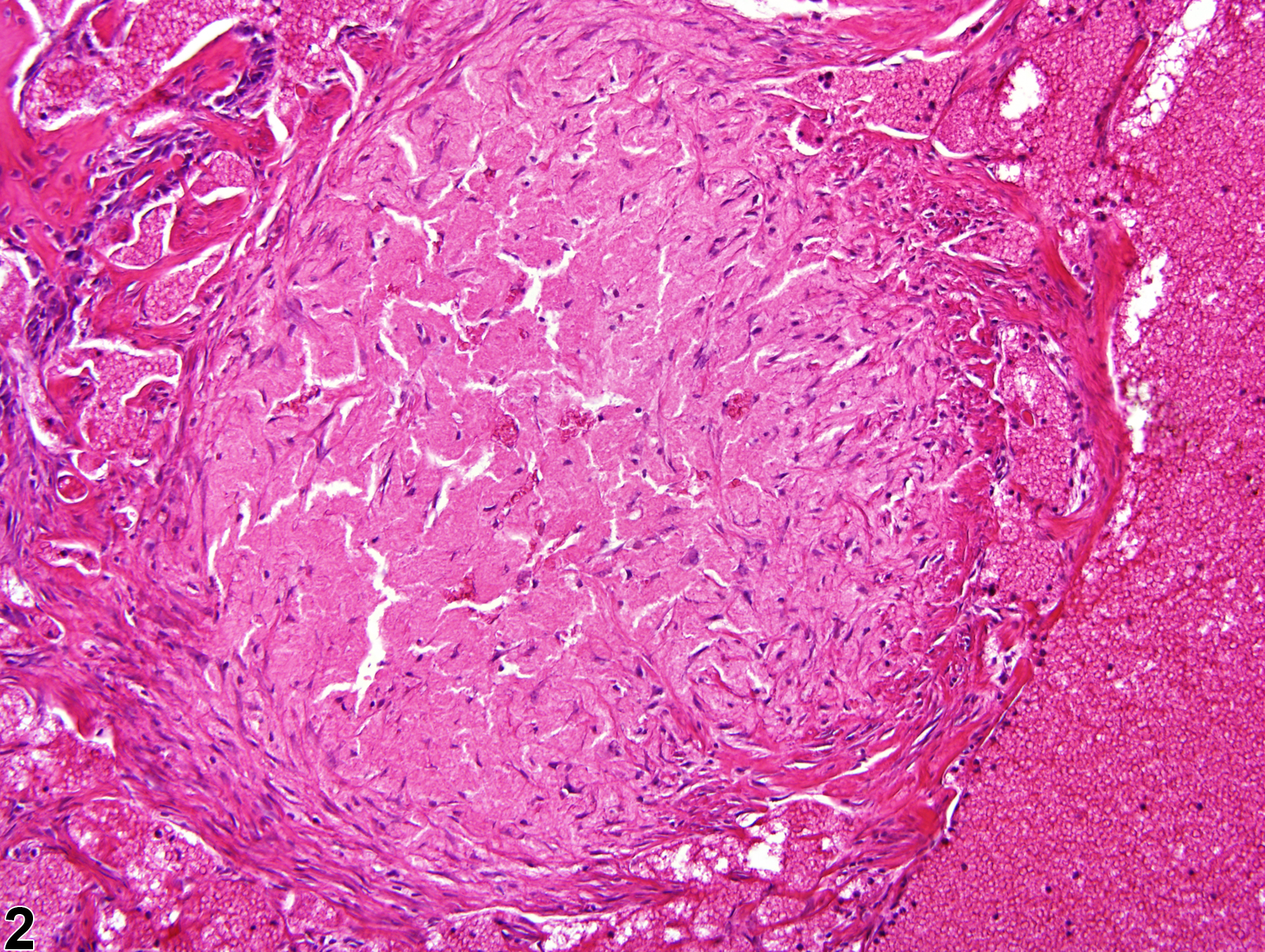 Image of fibrosis in the bone marrow from a male F344/N rat in a chronic study