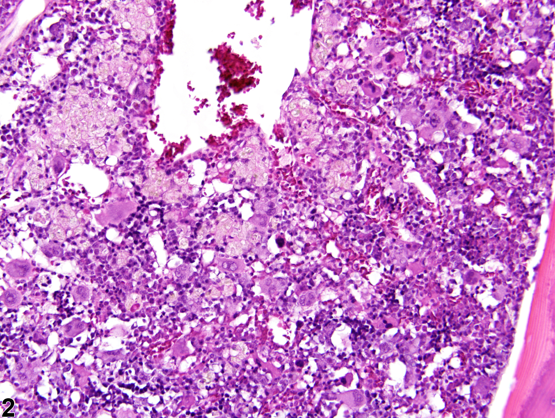 Image of infiltration cellular, histiocyte in the bone marrow from a female F344/N rat in a 2 year study