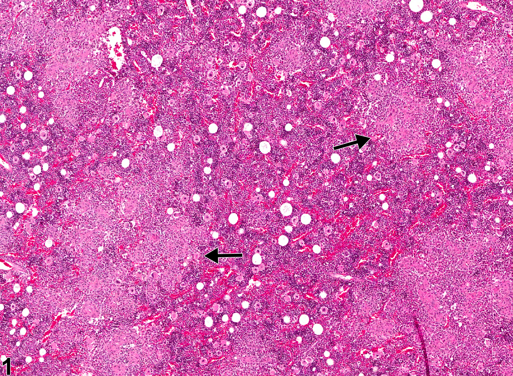 Image of inflammation in the bone marrow from a male F344/N rat in a chronic study