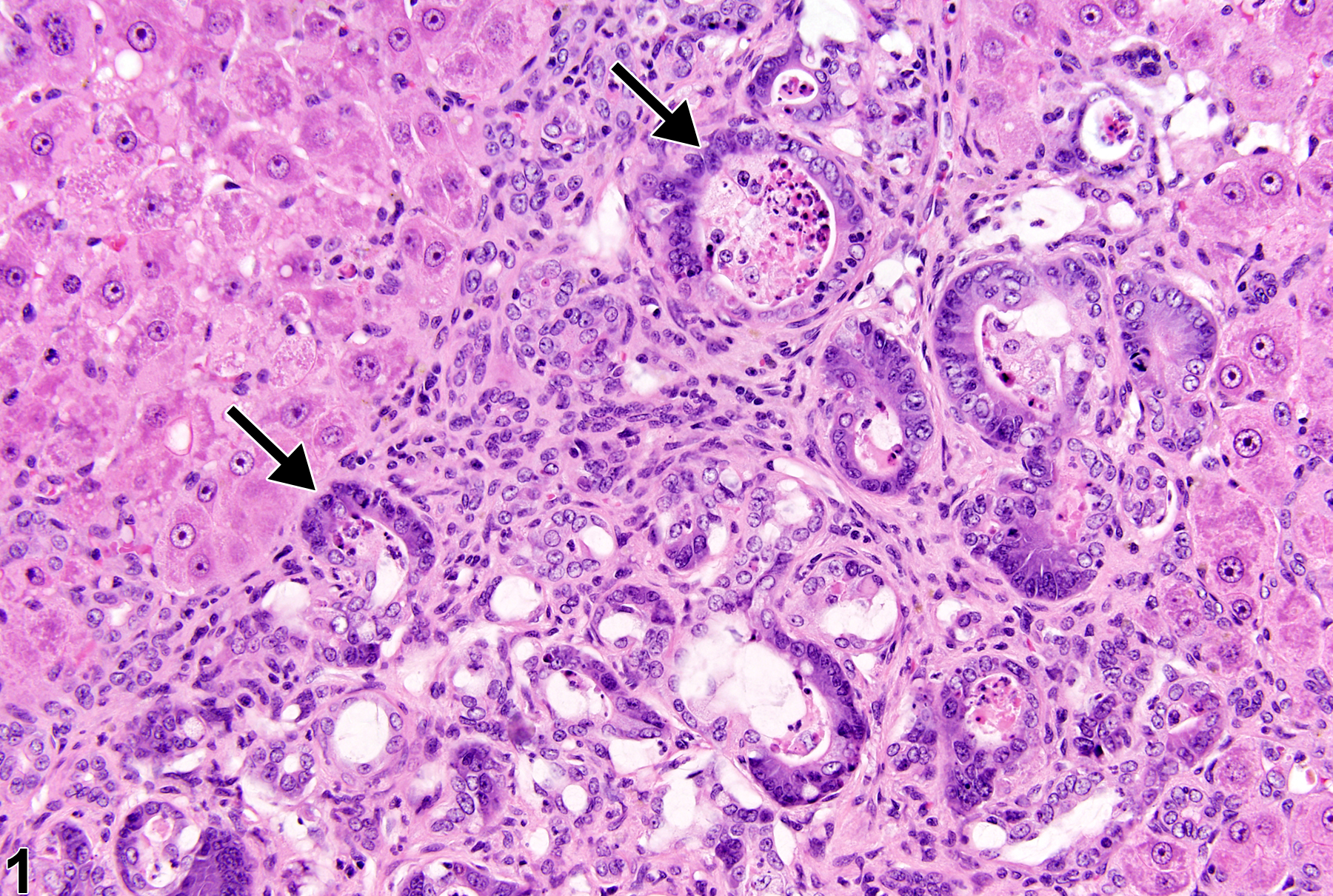 Image of cholangiofibrosis in the liver from a female Harlan Sprague-Dawley rat in a chronic study
