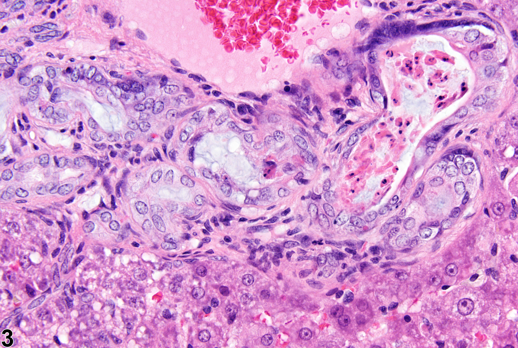 Image of cholangiofibrosis in the liver from a male  F344/N rat in a subchronic study