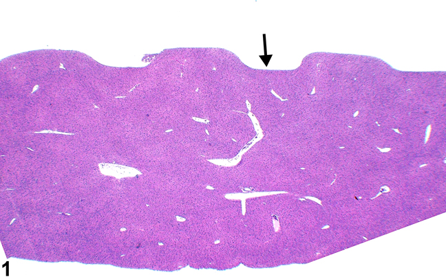 Image of artifact impression in the liver