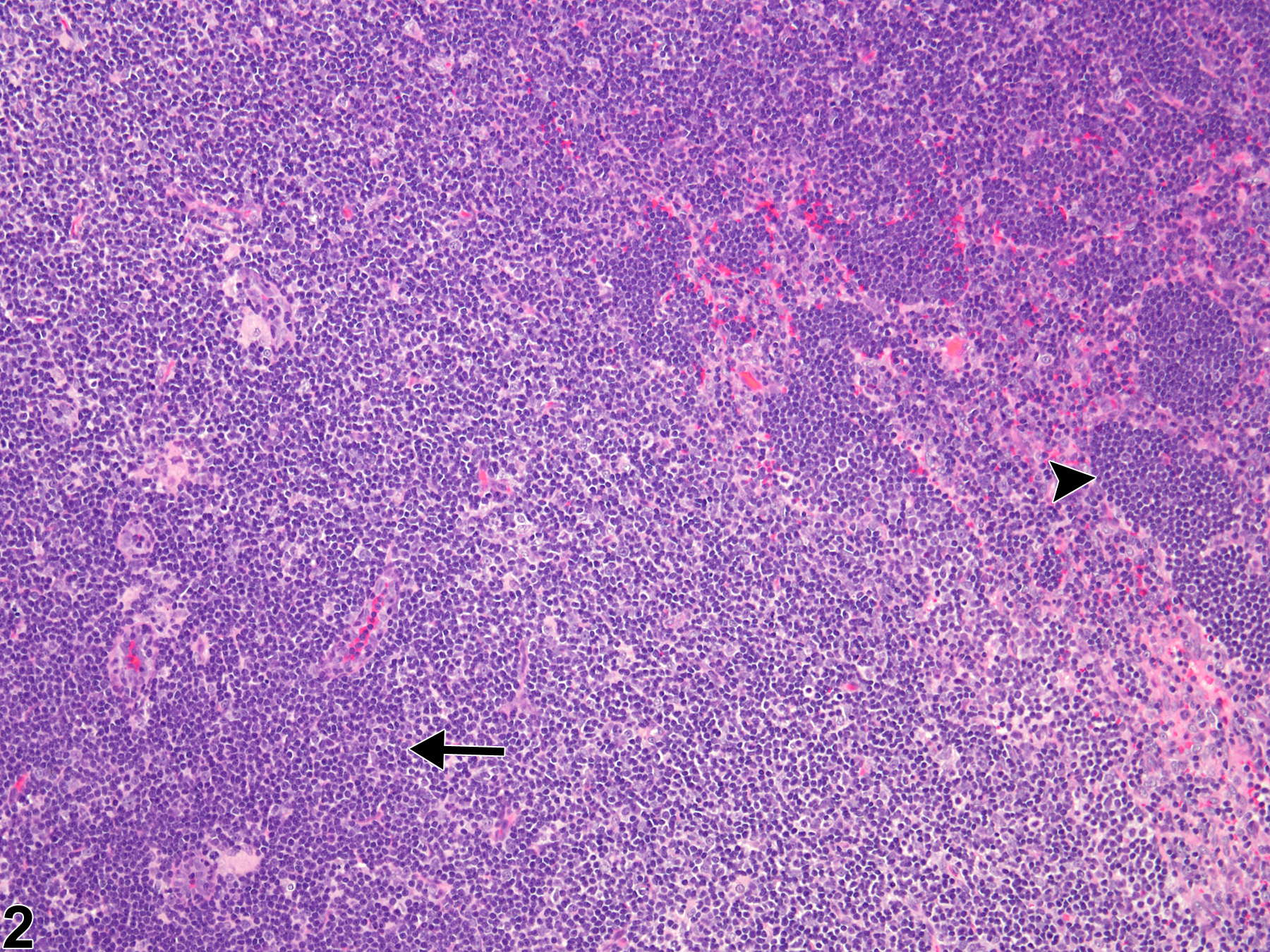 Image of hyperplasia, lymphocyte in the lymph node from a male B6C3F1/N mouse in a subchronic study