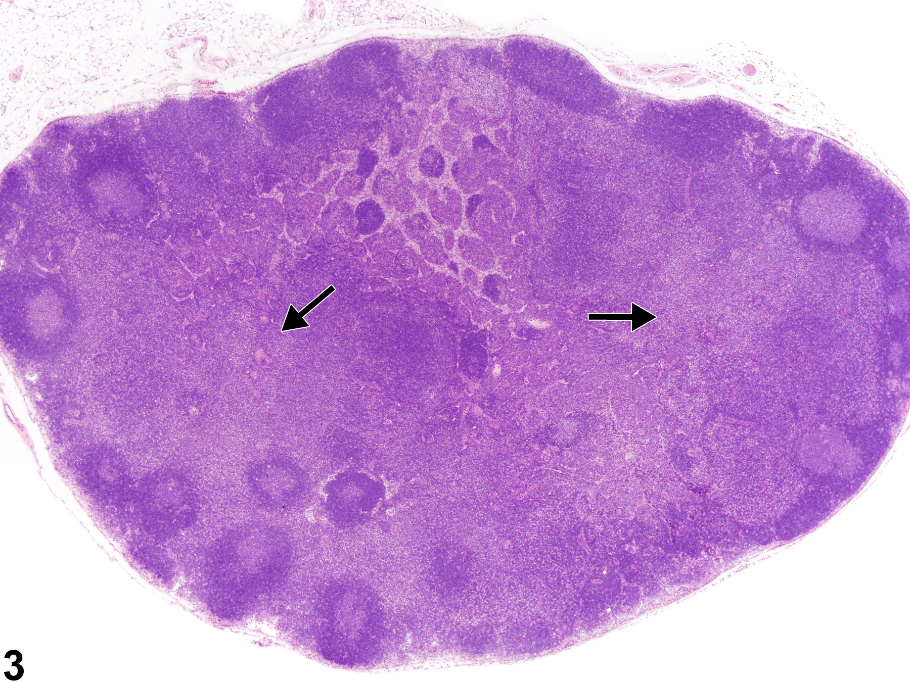 Image of hyperplasia, lymphocyte in the lymph node from a male B6C3F1/N mouse in a subchronic study