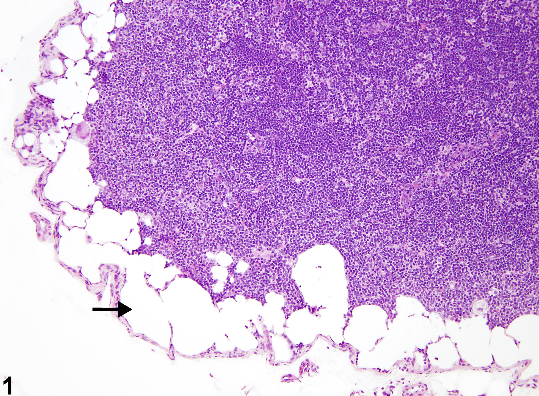 Image of lymphatic sinus, ectasia in the lymph node from a female F344/N rat in a subchronic study