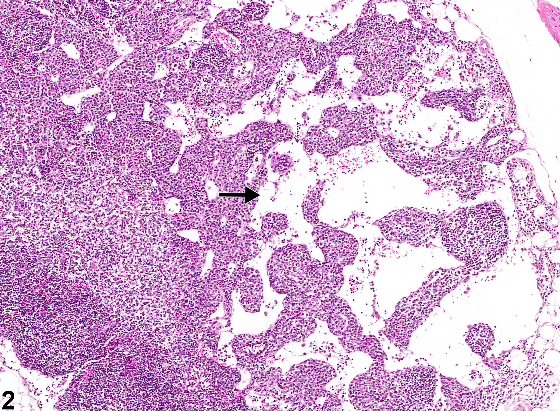 Image of lymphatic sinus, ectasia in the lymph node from a female B6C3F1/N mouse in a chronic study