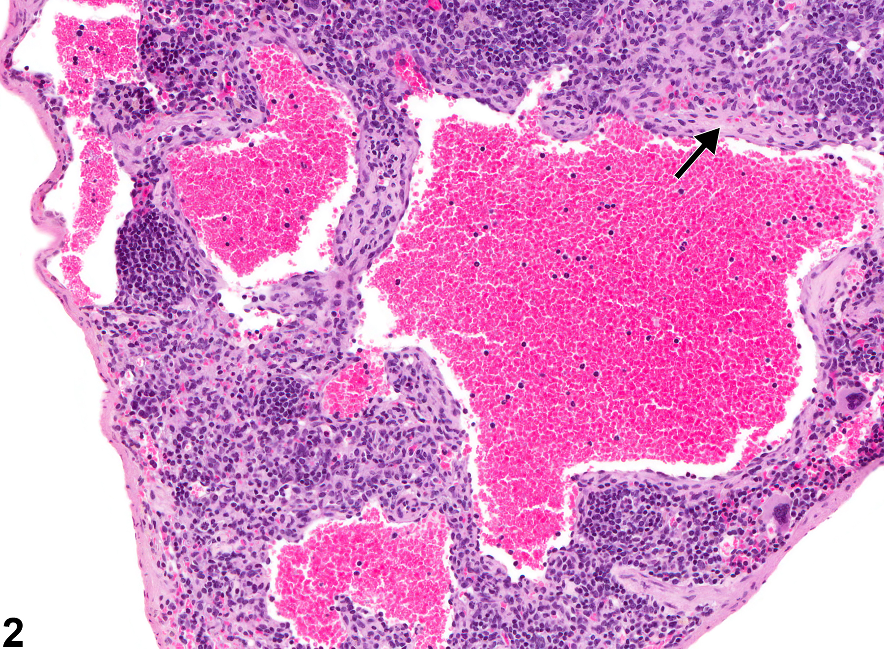 Image of angiectasis in the spleen from a female B6C3F1/N mouse in a chronic study