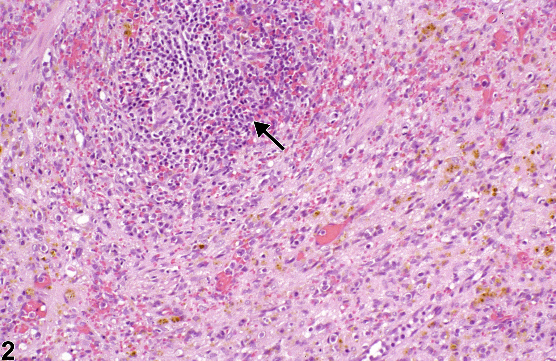 Image of fibrosis in the spleen from a male F344/N rat in a chronic study