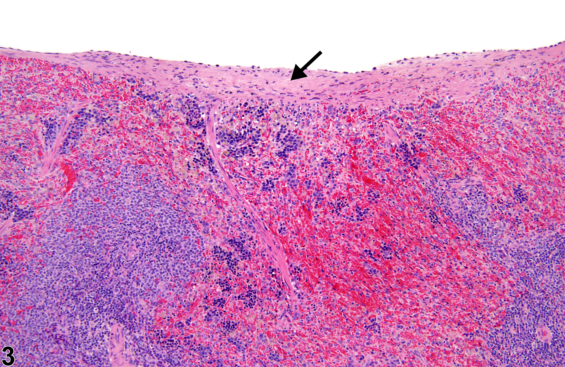 Image of fibrosis in the spleen from a male F344/N rat in a chronic study