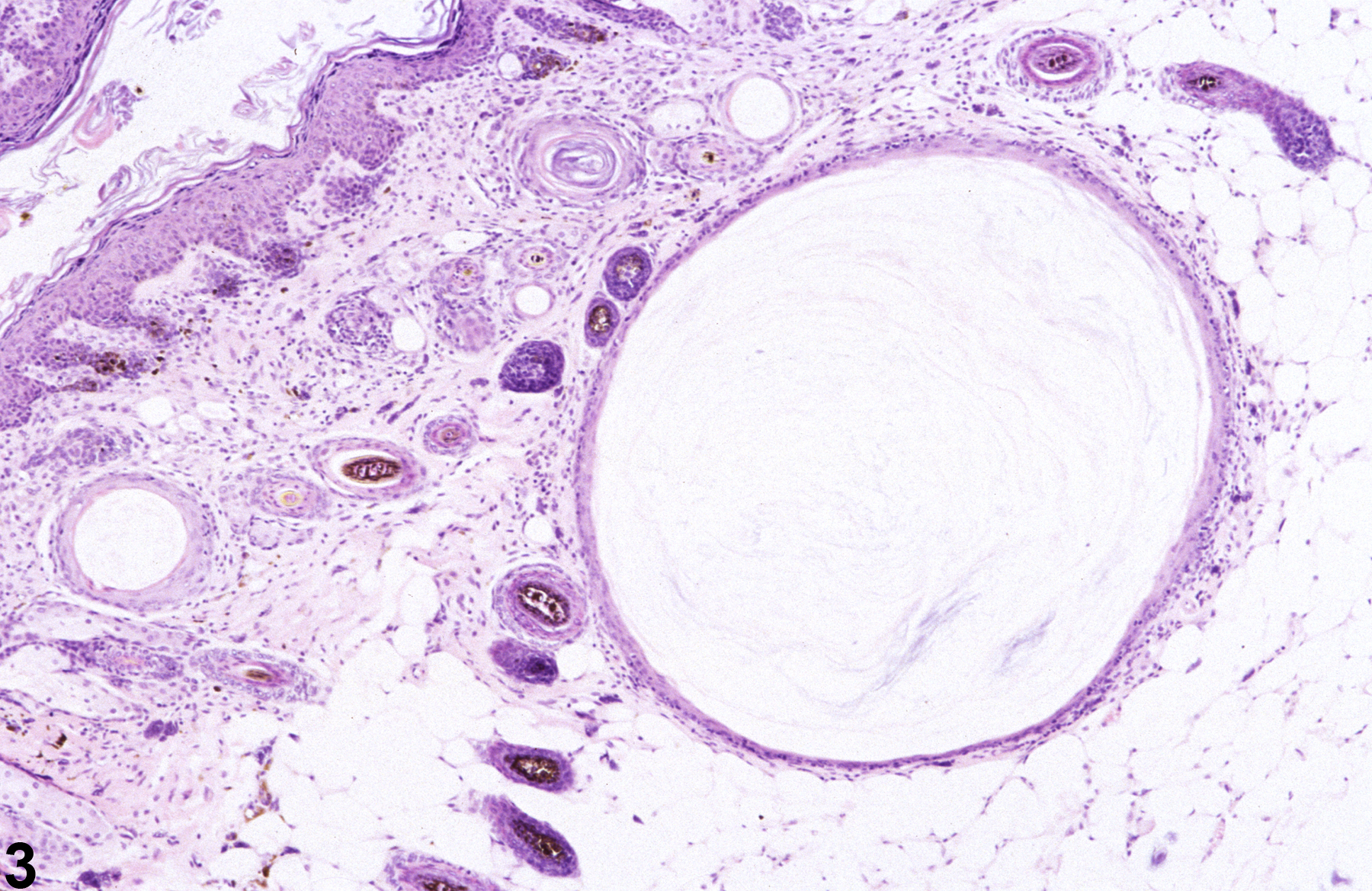 Image of cyst in the skin epithelium from a male B6C3F1 mouse in a chronic study