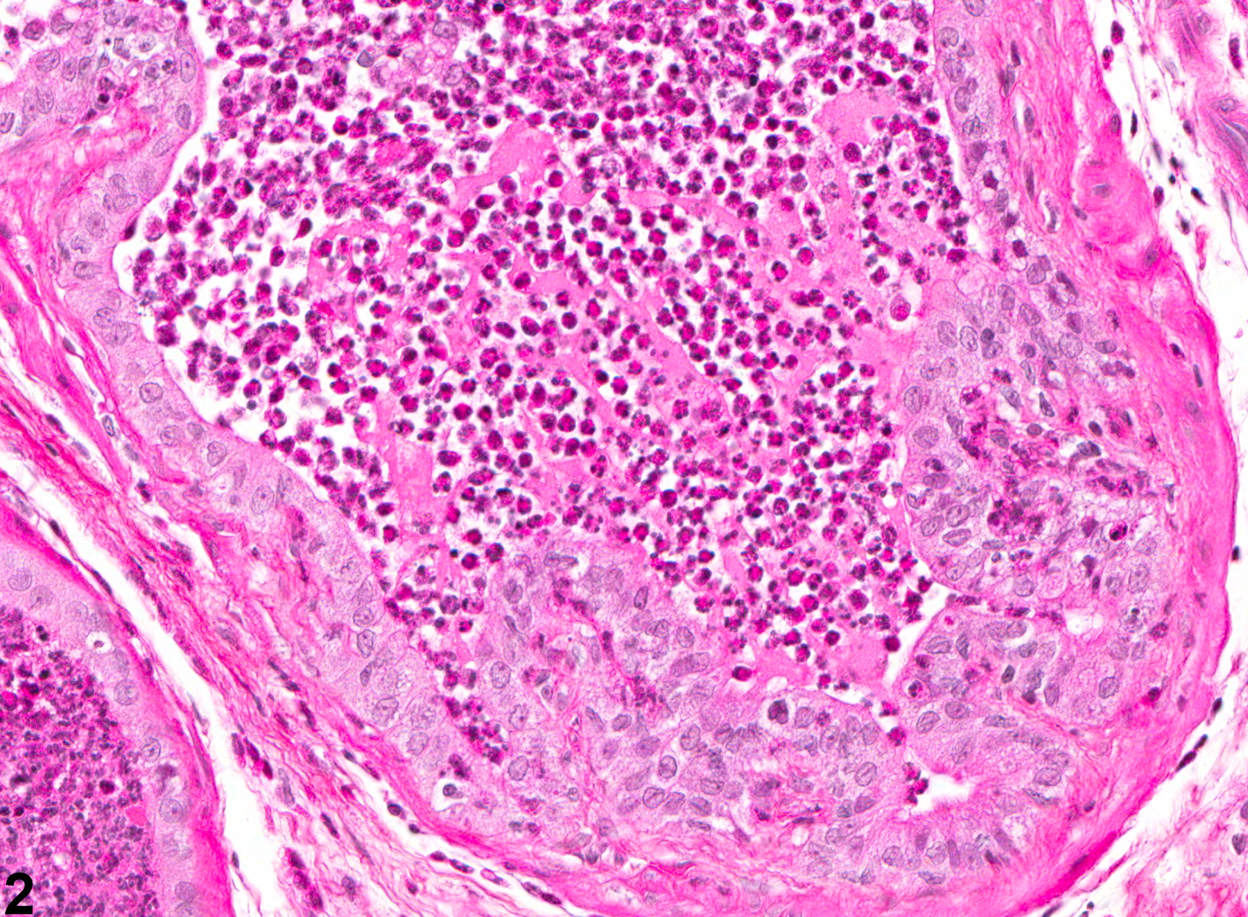 Image of acute inflammation in the coagulating gland from a male Wistar rat in a chronic study