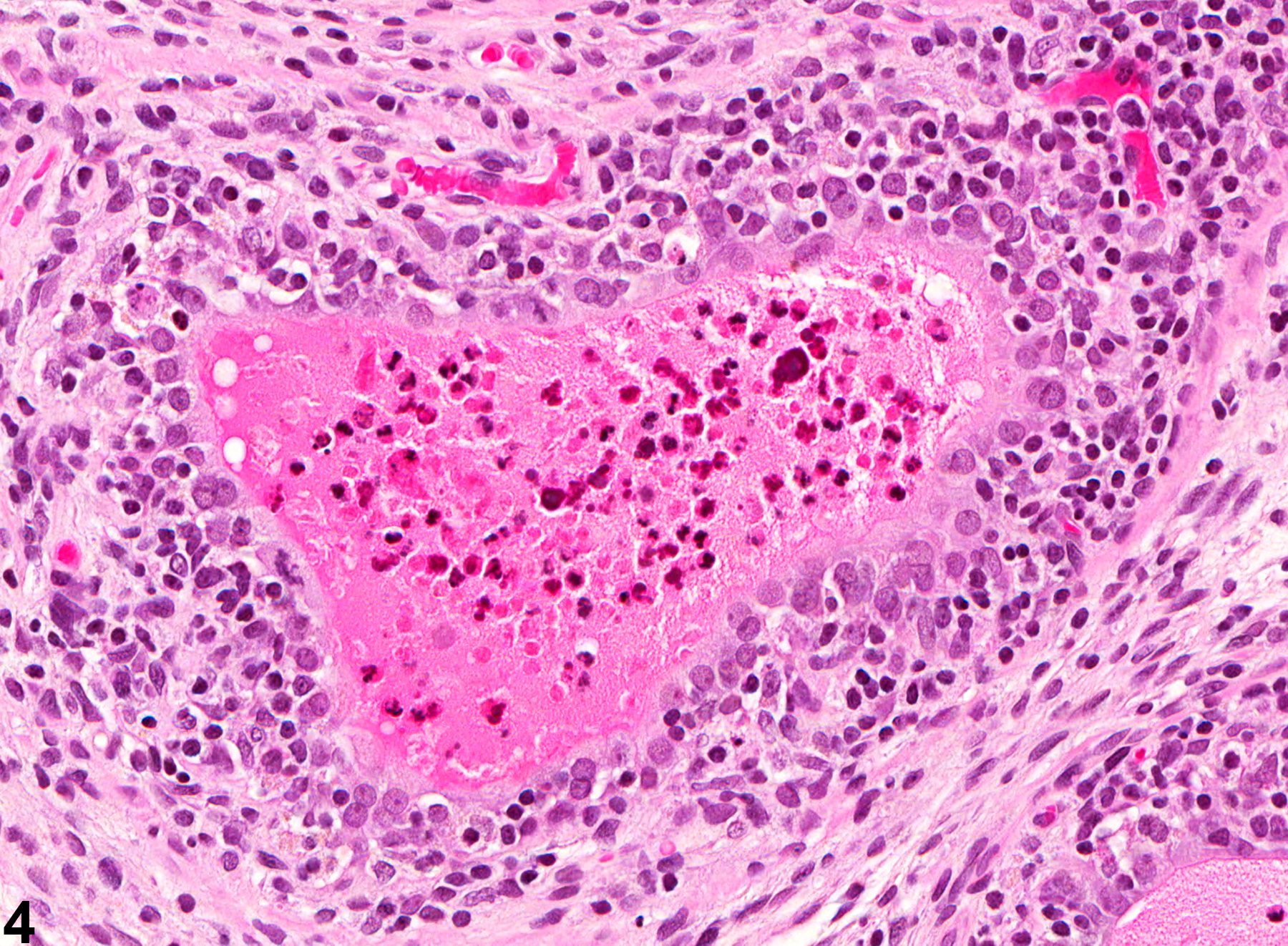 Image of chronic to chronic-active inflammation in the coagulating gland from a male F344/N rat in a chronic study