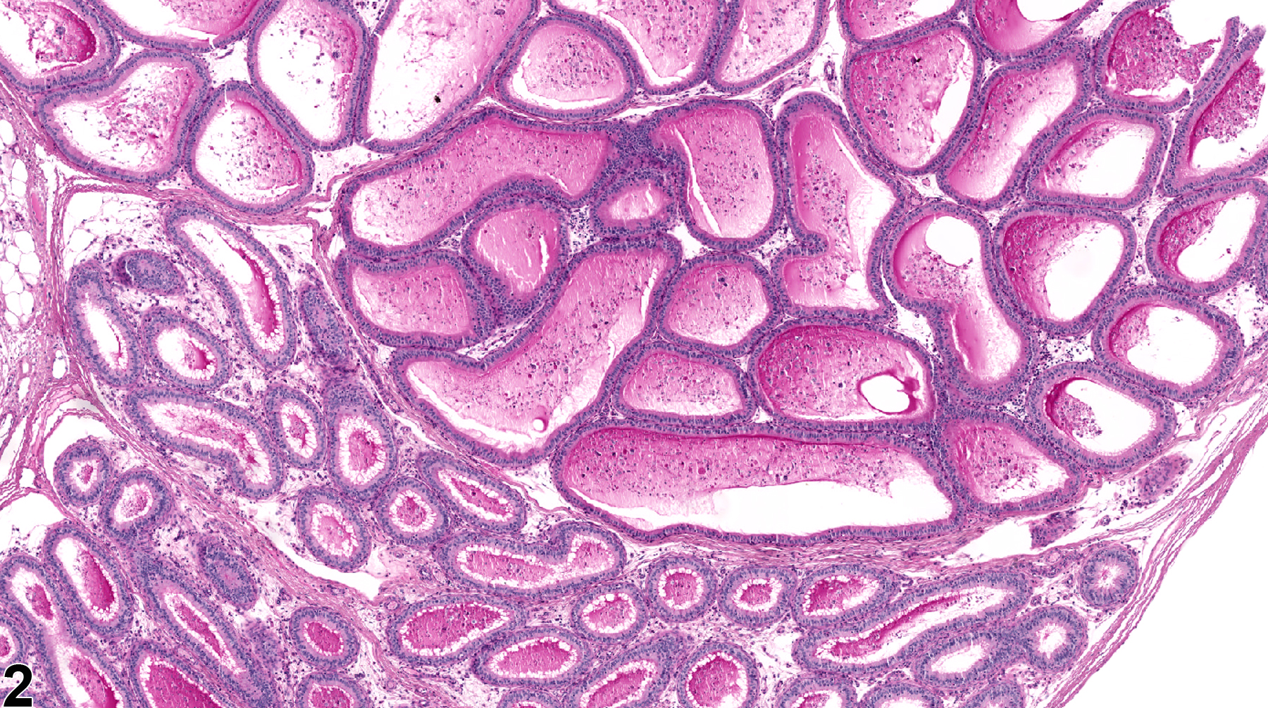 Image of duct dilation in the epididymis from a  rat