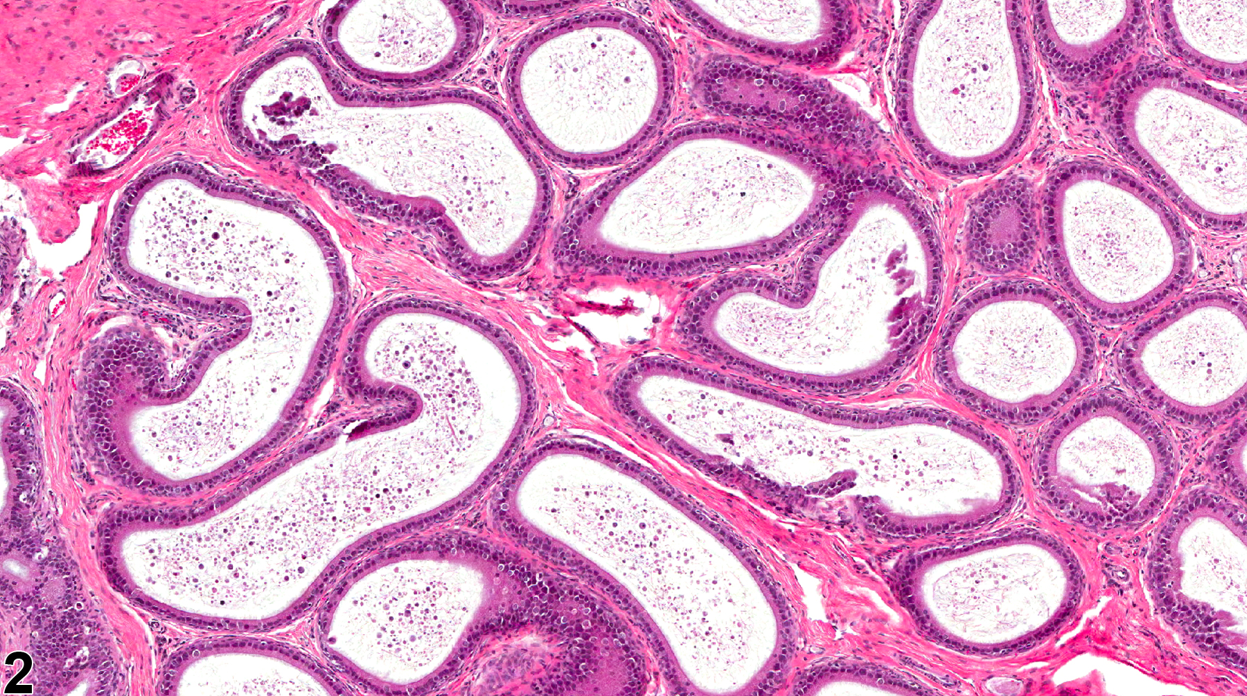 Image of duct exfoliated germ cell in the epididymis from a male F344/N rat in a subchronic study