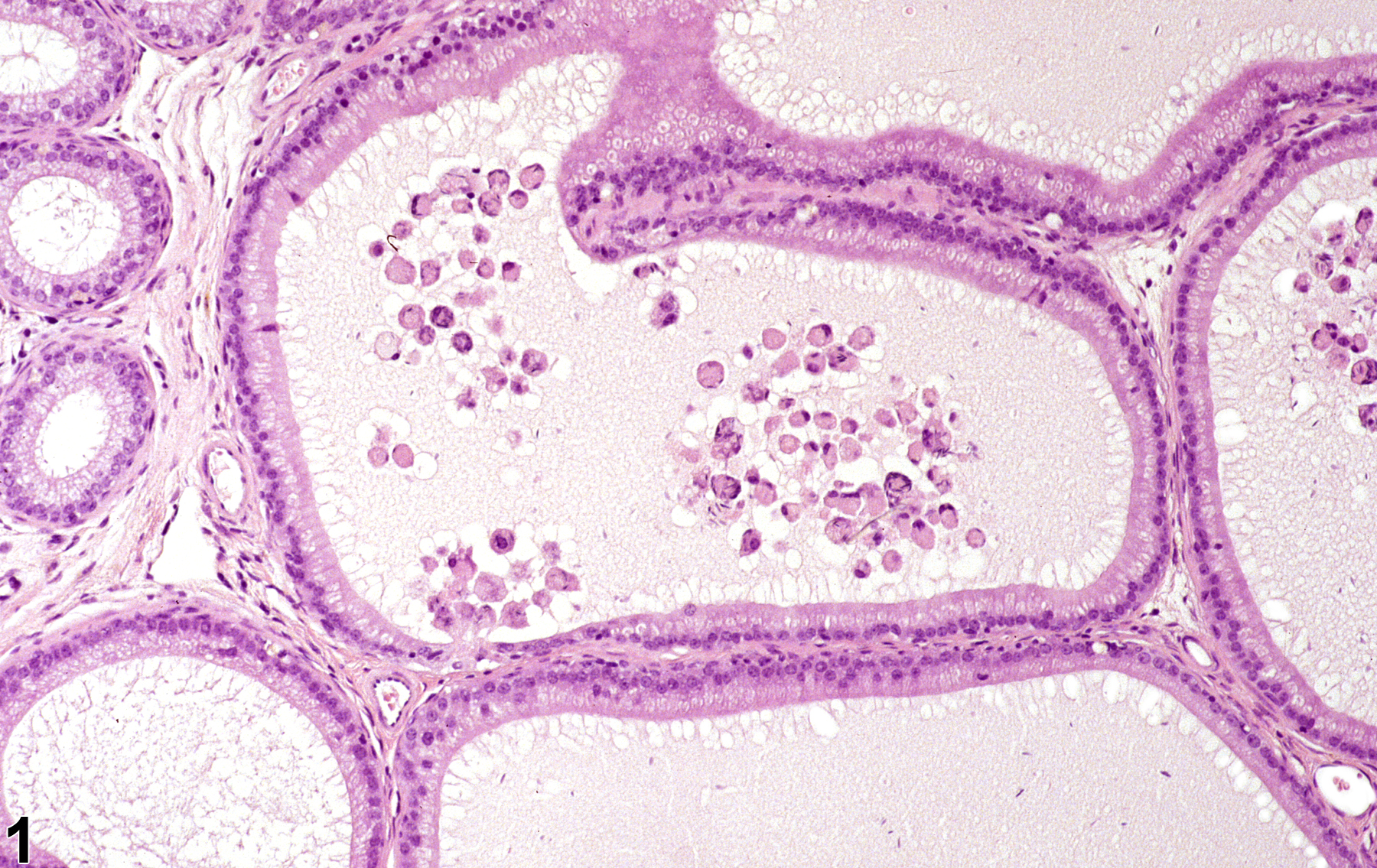 Image of epithelial degeneration in the epididymis from a male B6C3F1 mouse in a chronic study