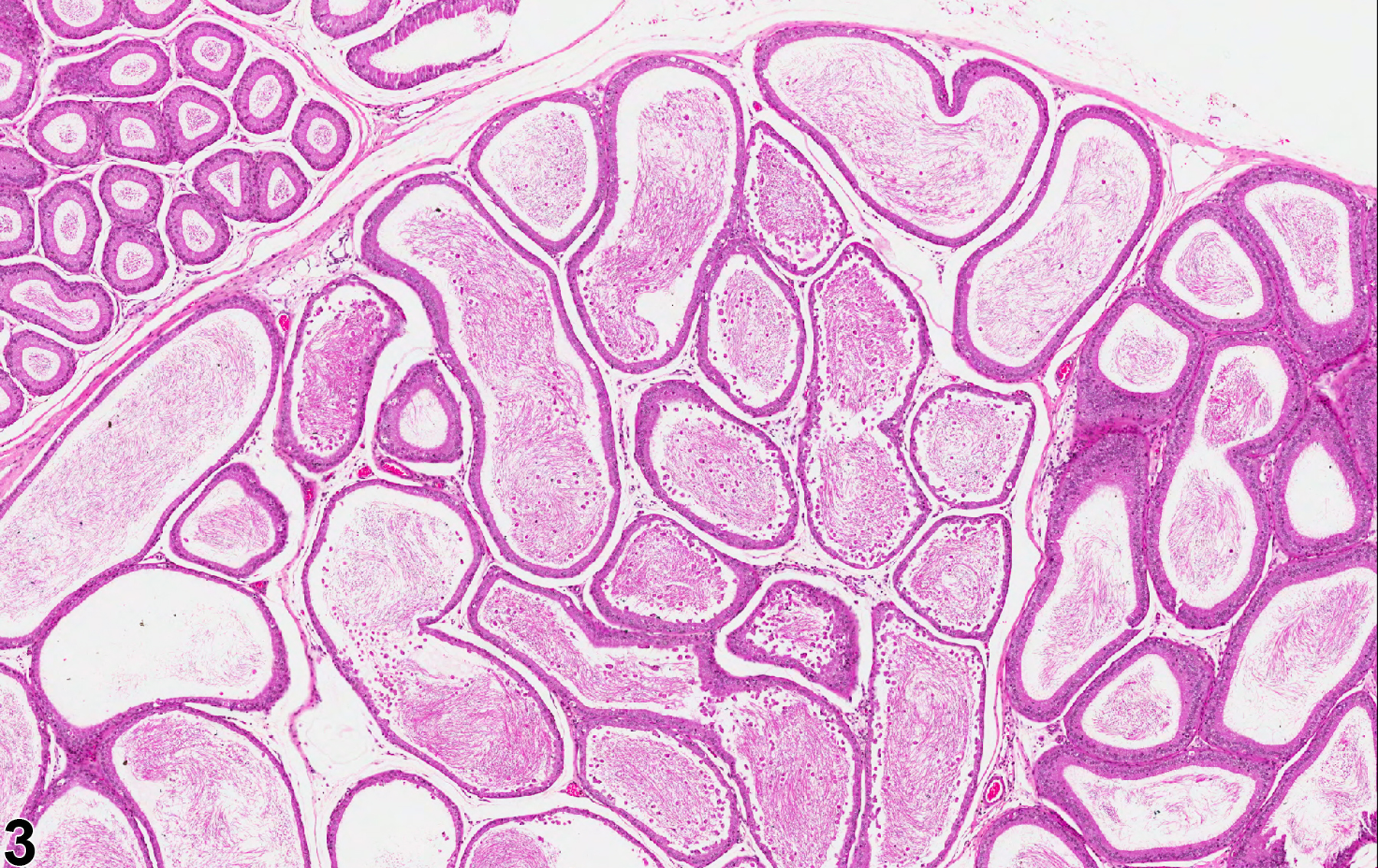 Image of epithelial degeneration in the epididymis from a  rat