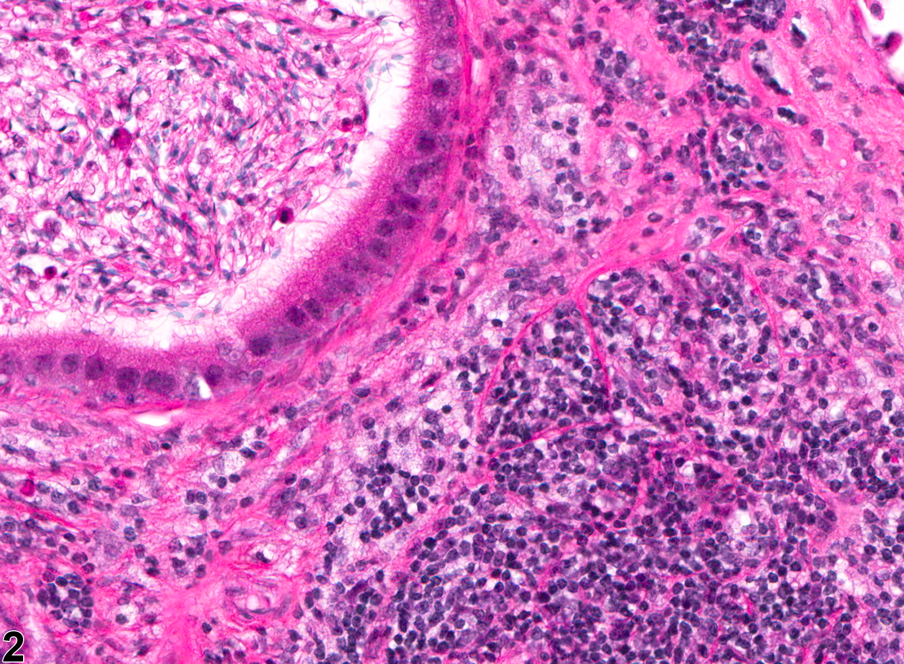 Image of inflammation in the epididymis from a male B6C3F1 mouse in a chronic study