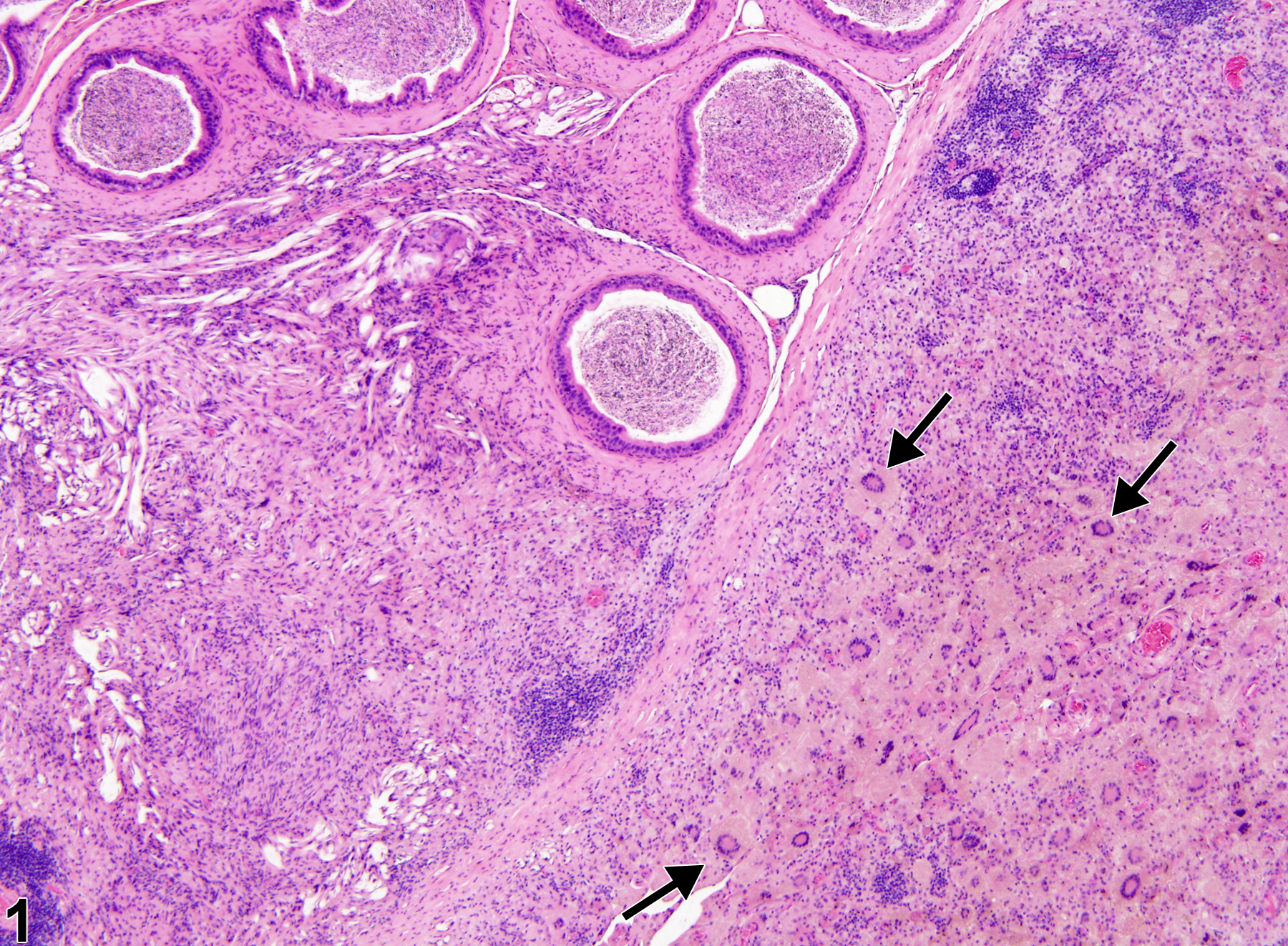 Image of sperm granuloma in the epididymis from a male B6C3F1 mouse in a chronic study