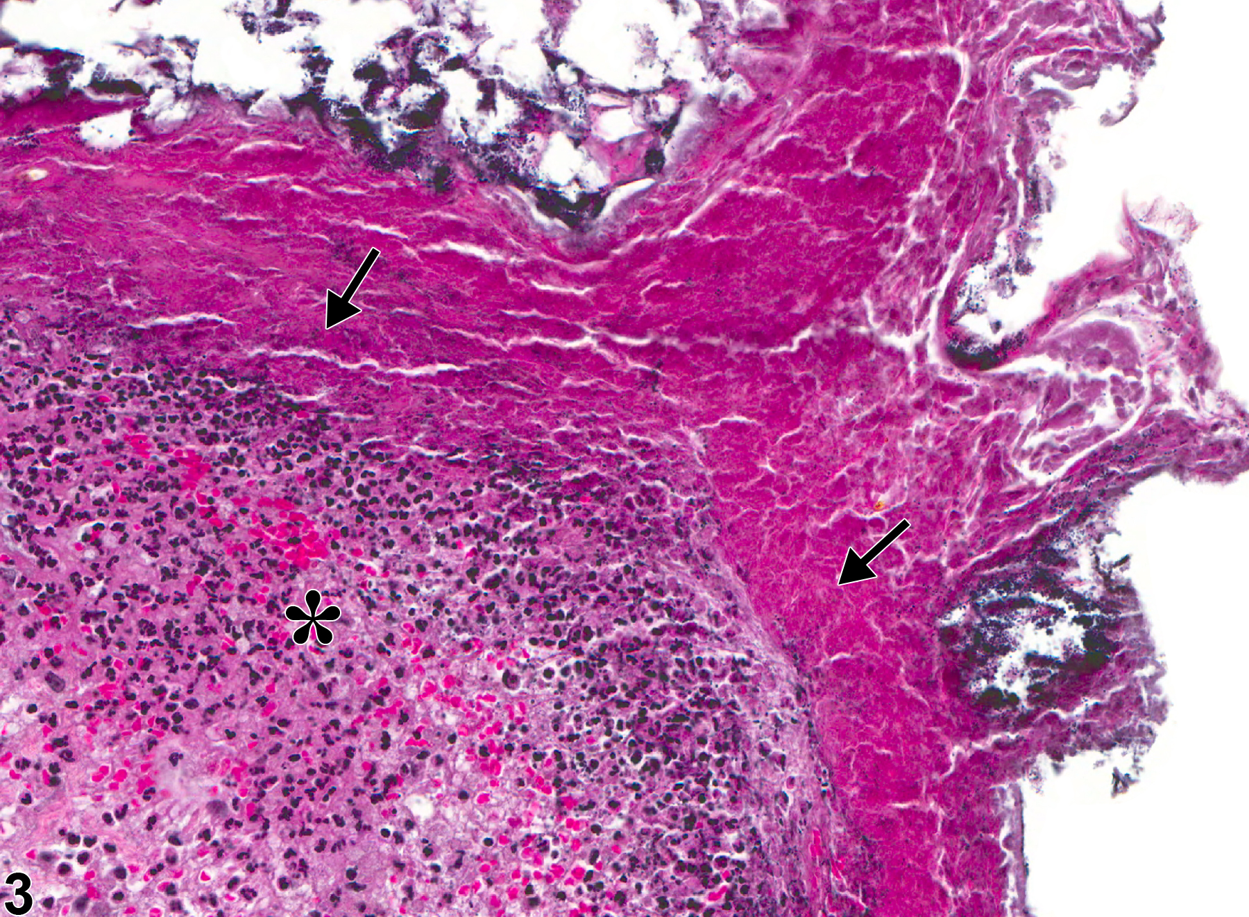 Image of prepuce inflammation in the penis from a male F344/N rat in a chronic study