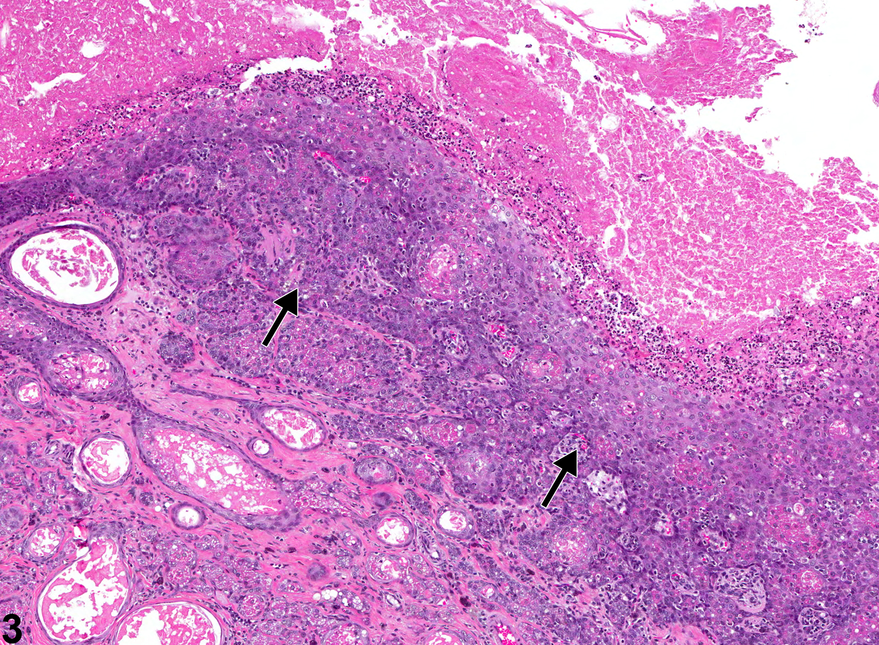 Image of epithelial hyperplasia in the preputial gland from a male F344/N rat in a chronic study
